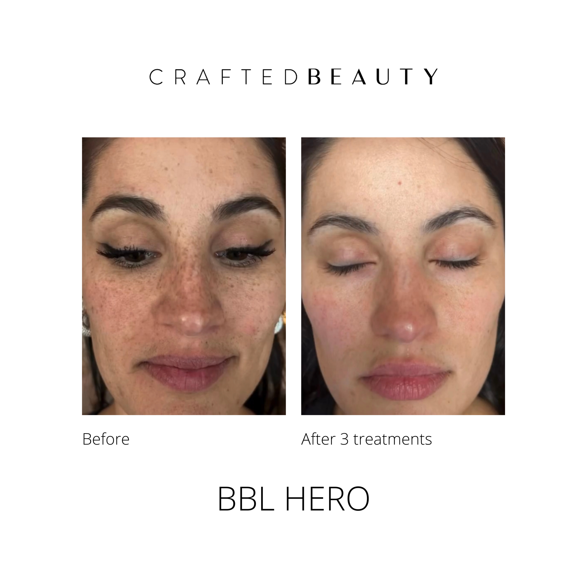BBL HERO results before and after
