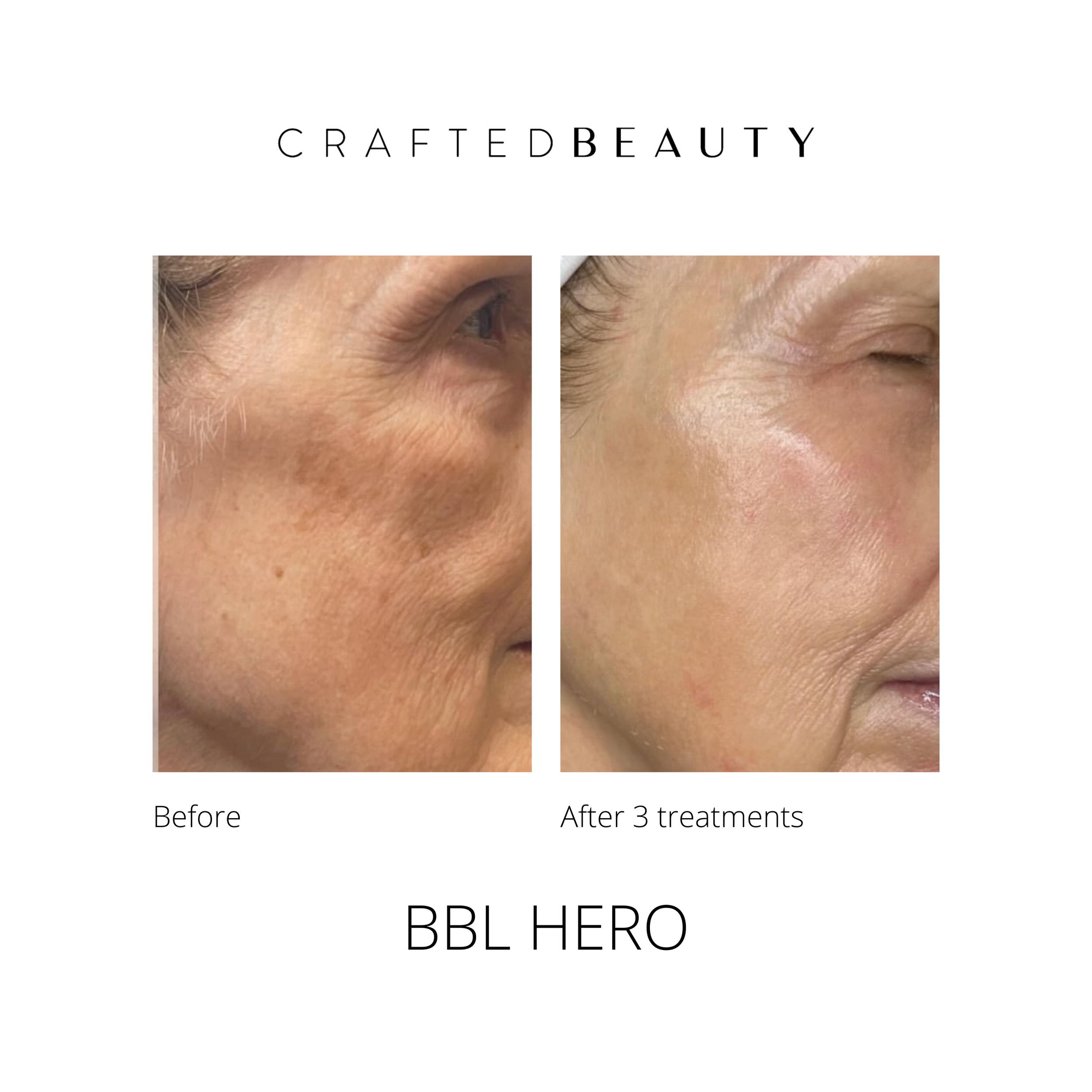 BBL HERO results before and after
