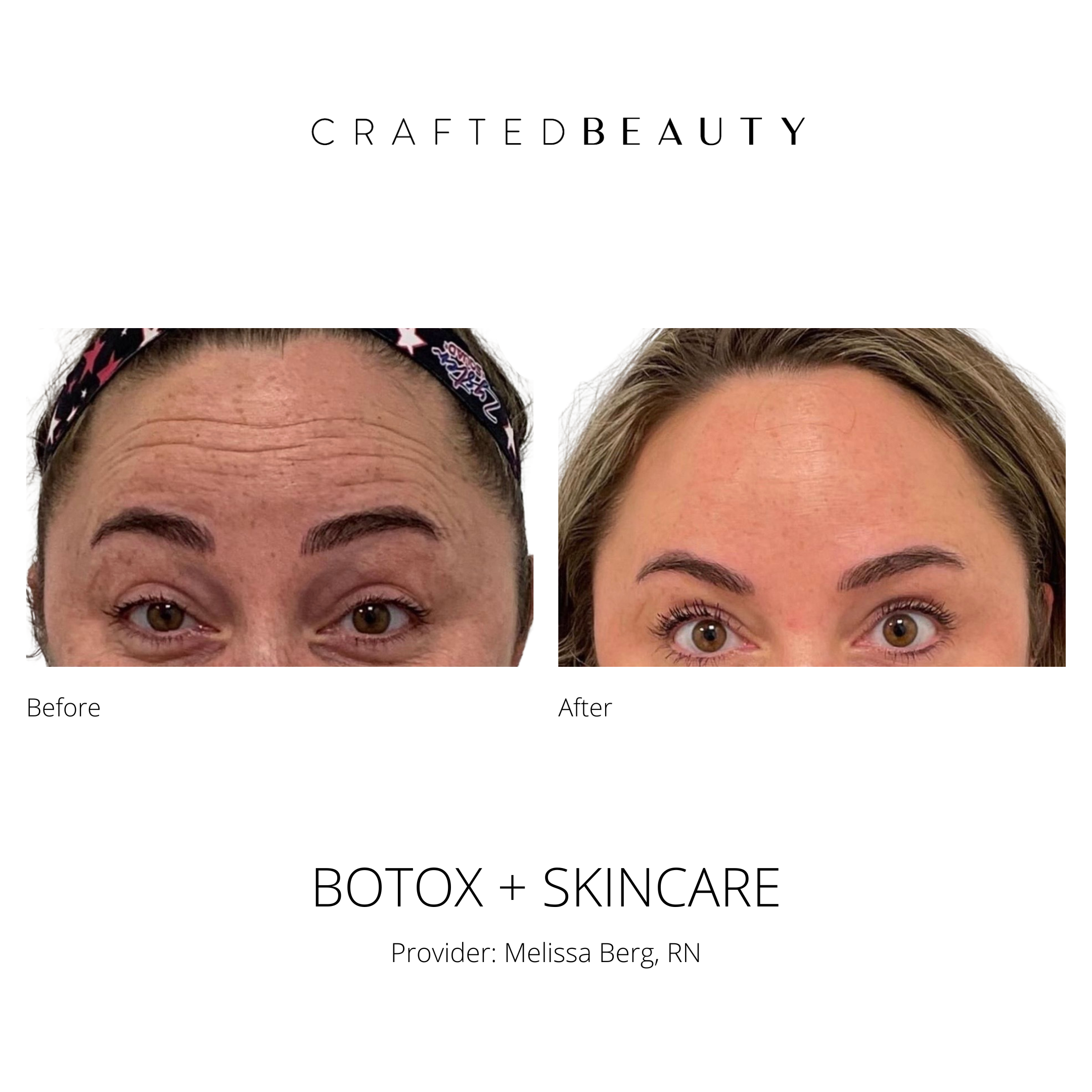 Botox results before and after