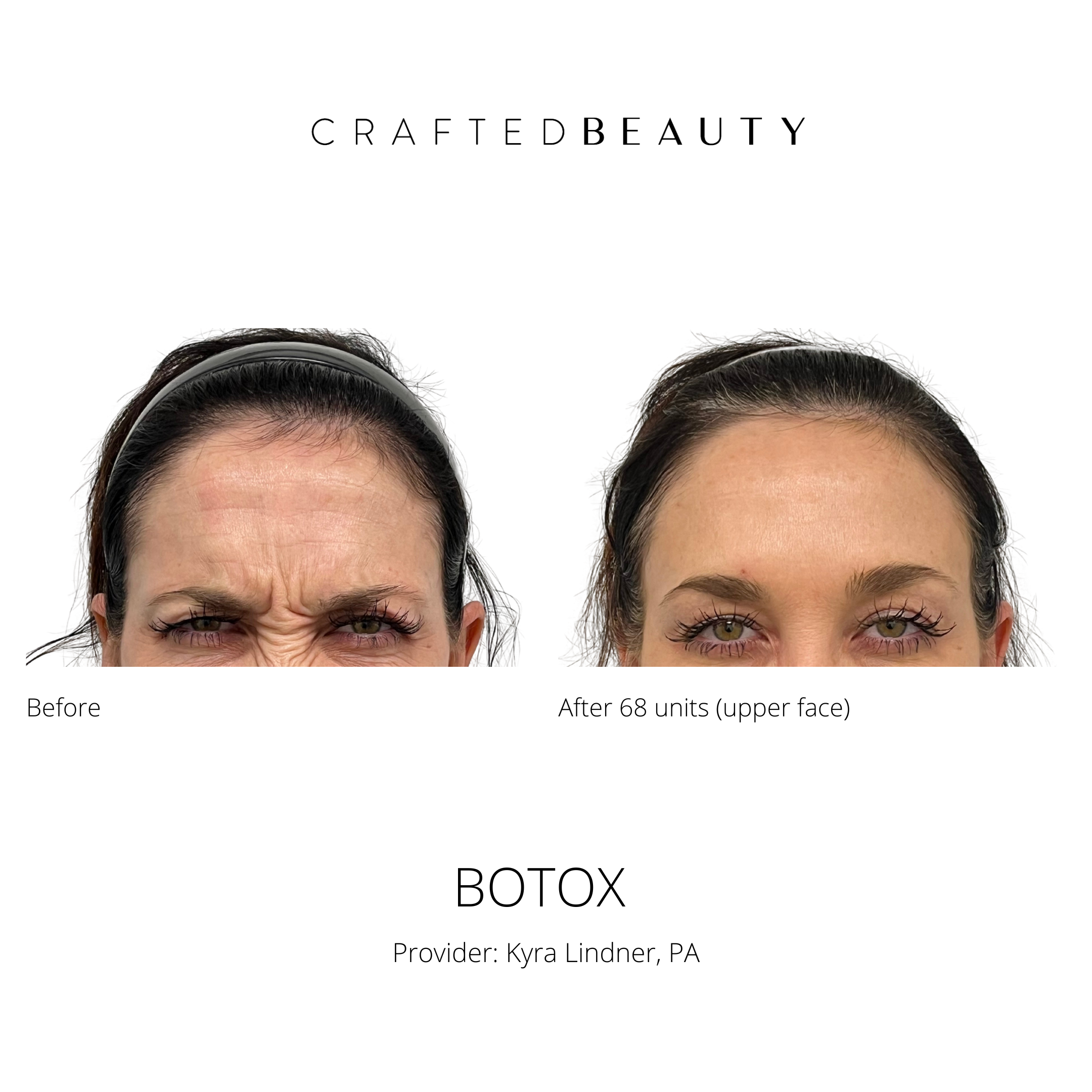 Botox results before and after
