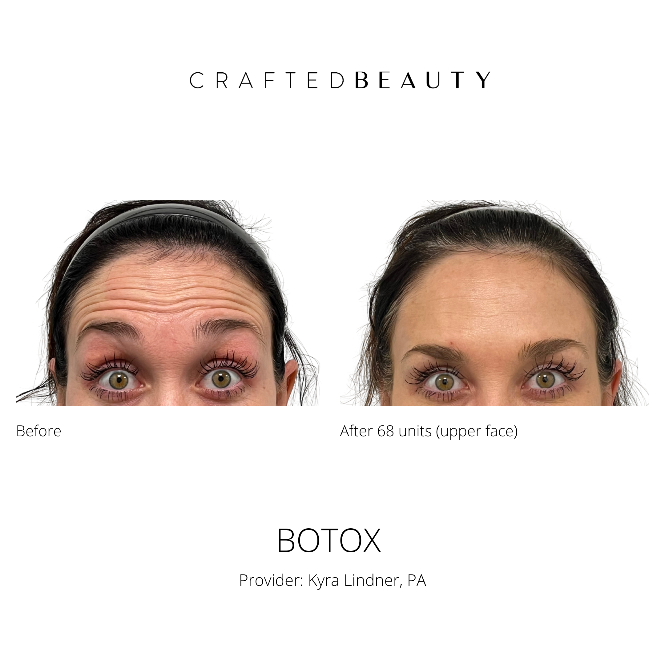 Botox results before and after