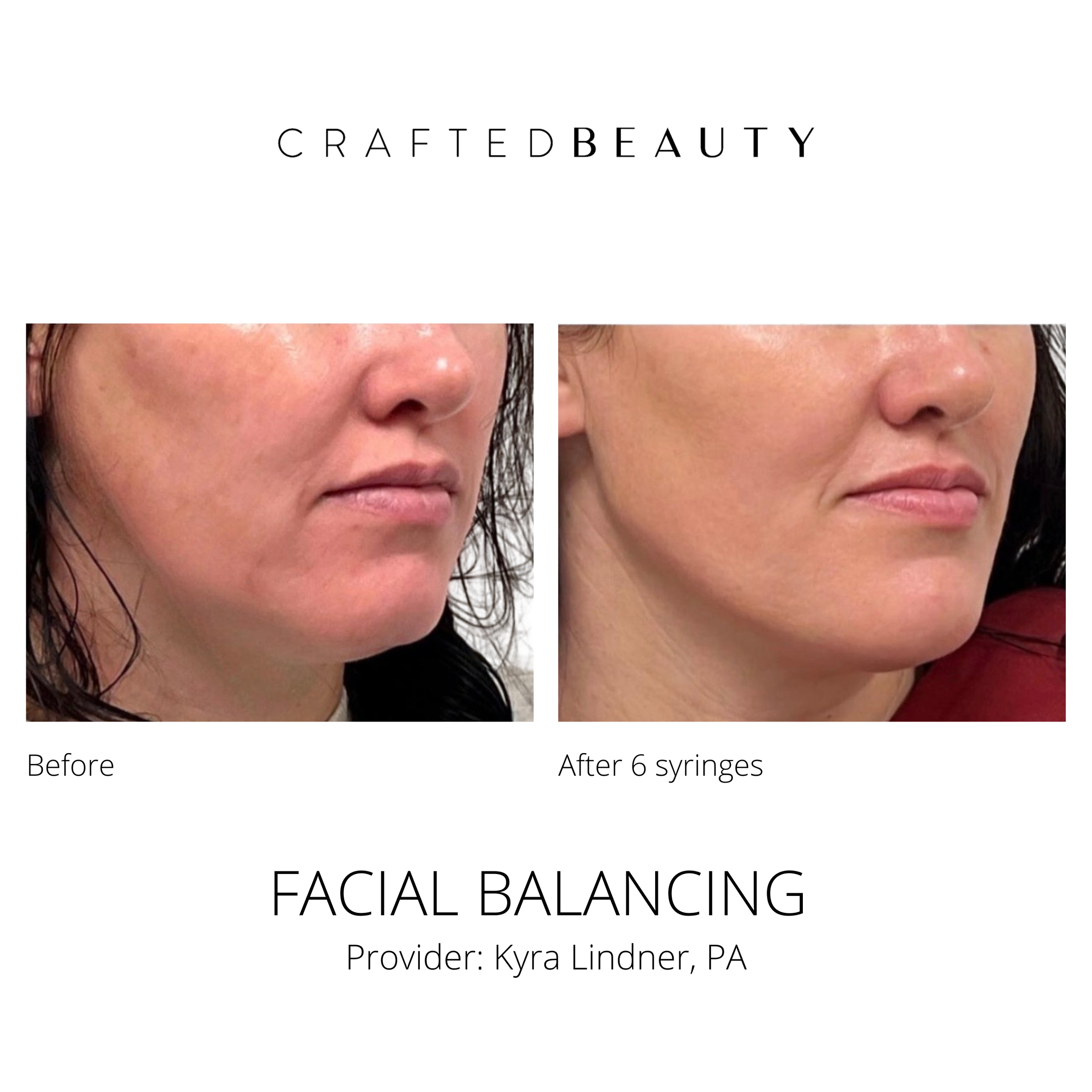Filler results before and after