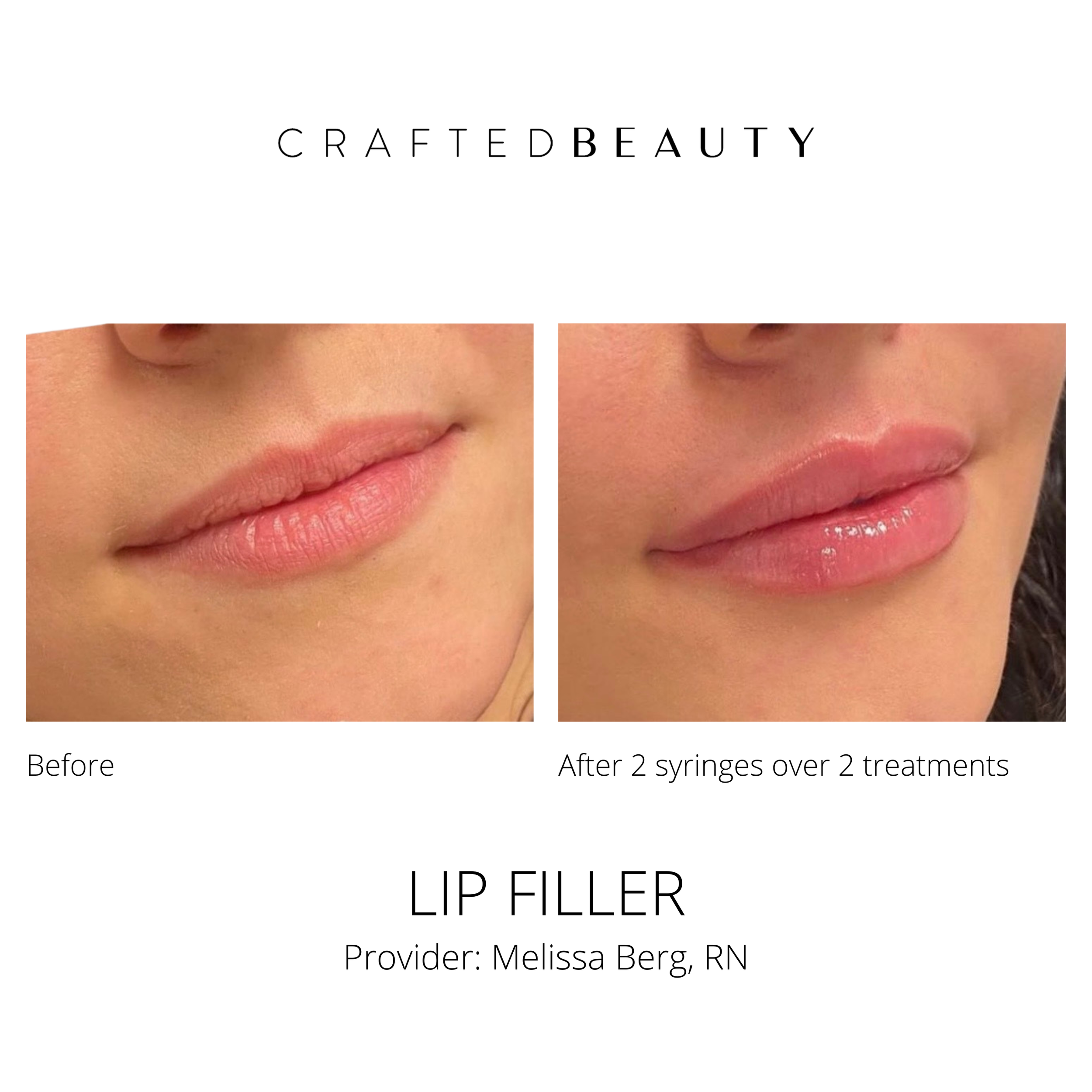 Filler results before and after