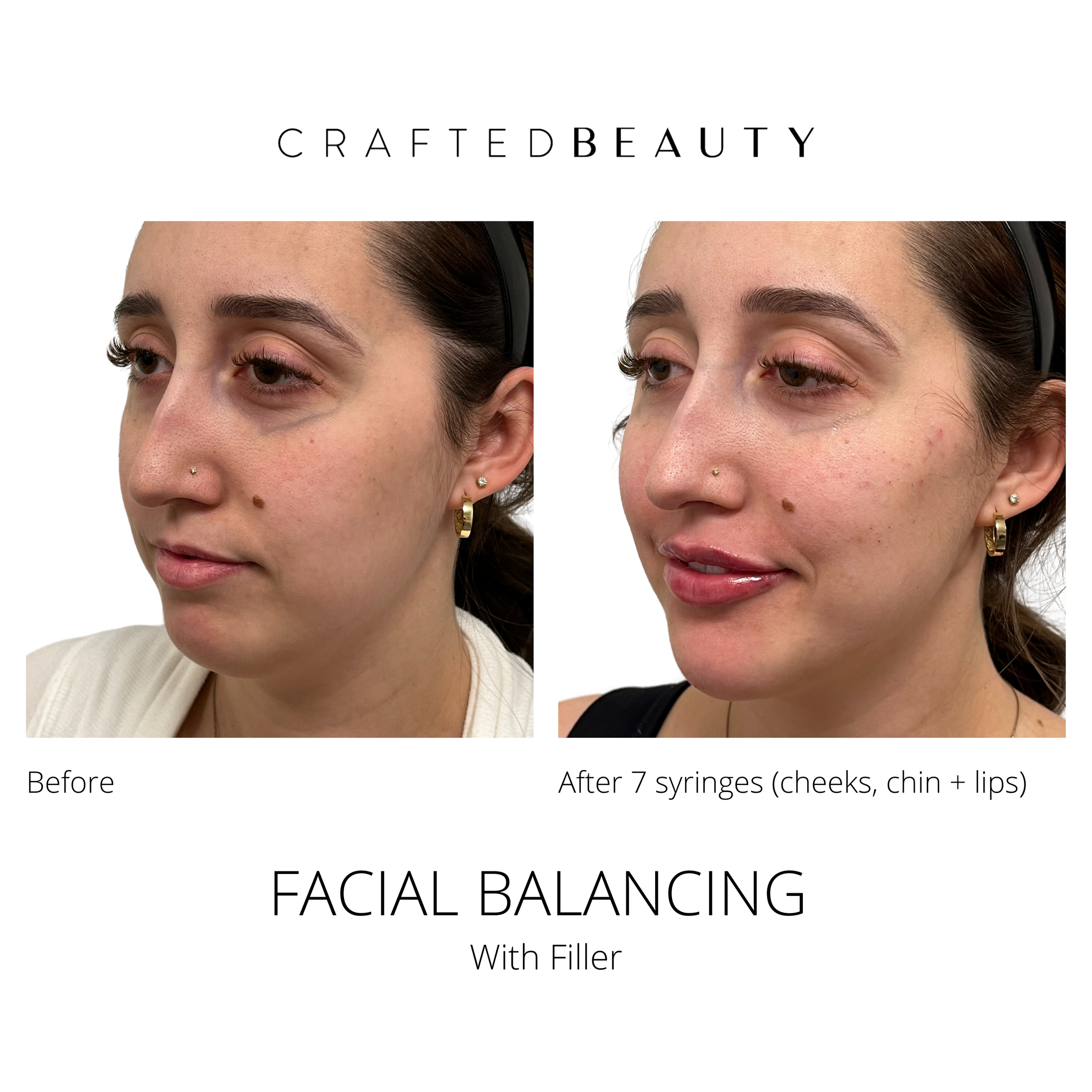 Dermal Fillers