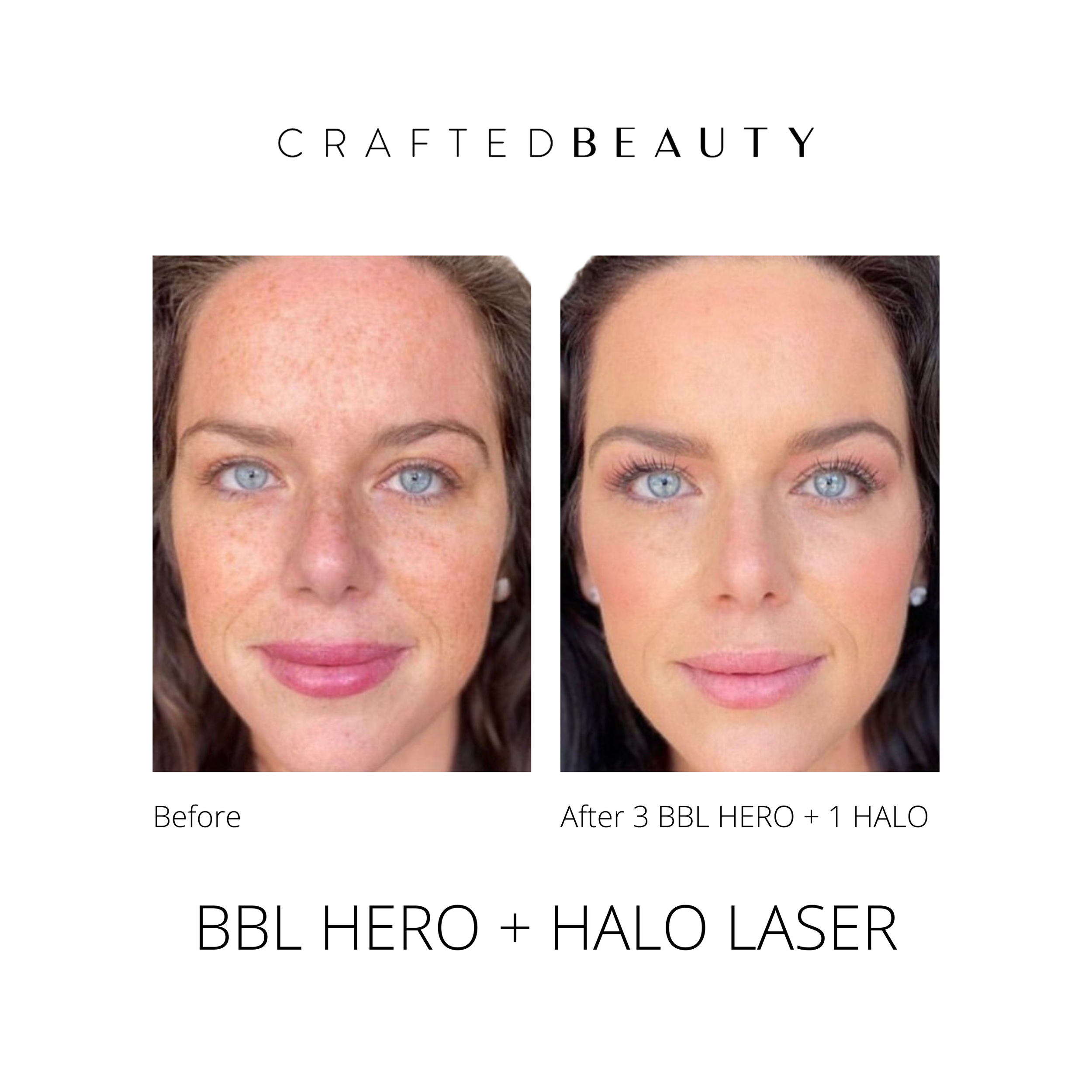 Halo laser results before and after