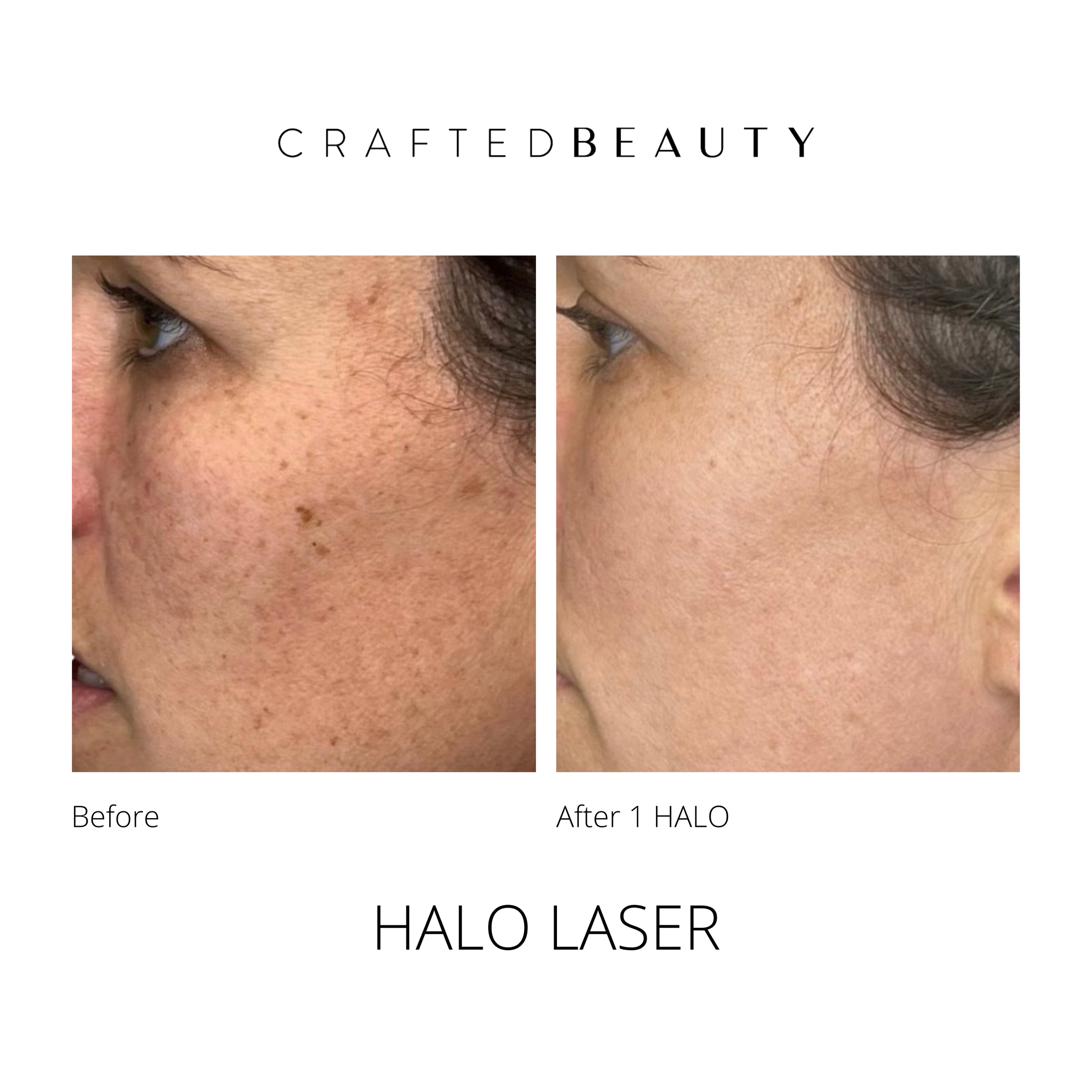 Halo laser results before and after