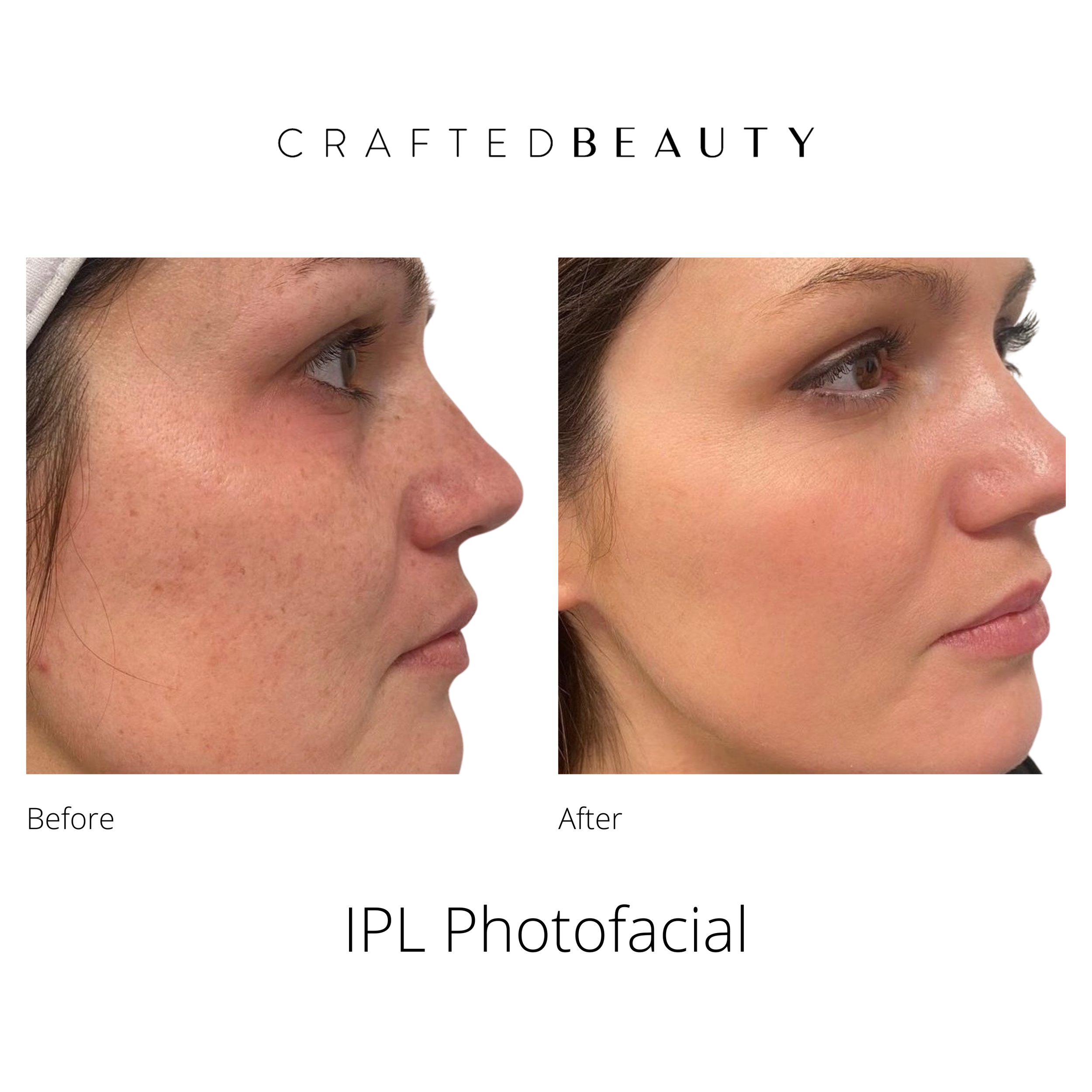 Lumecca IPL