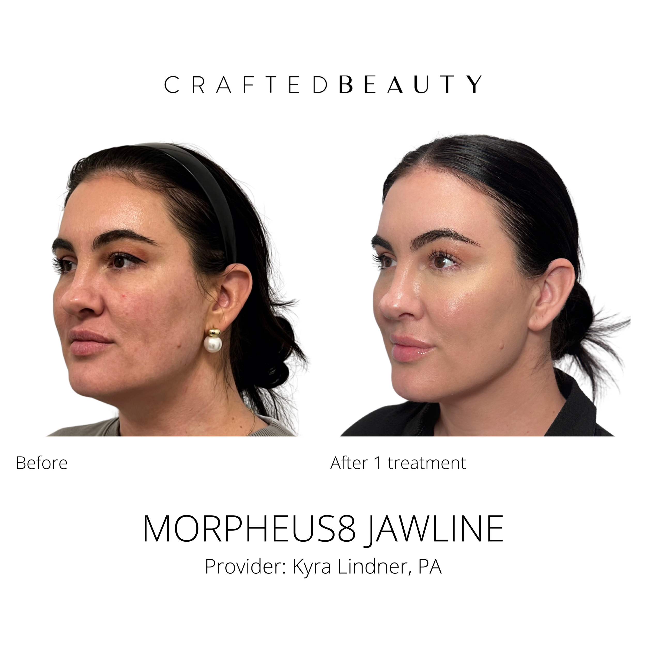 Morpheus8 results before and after