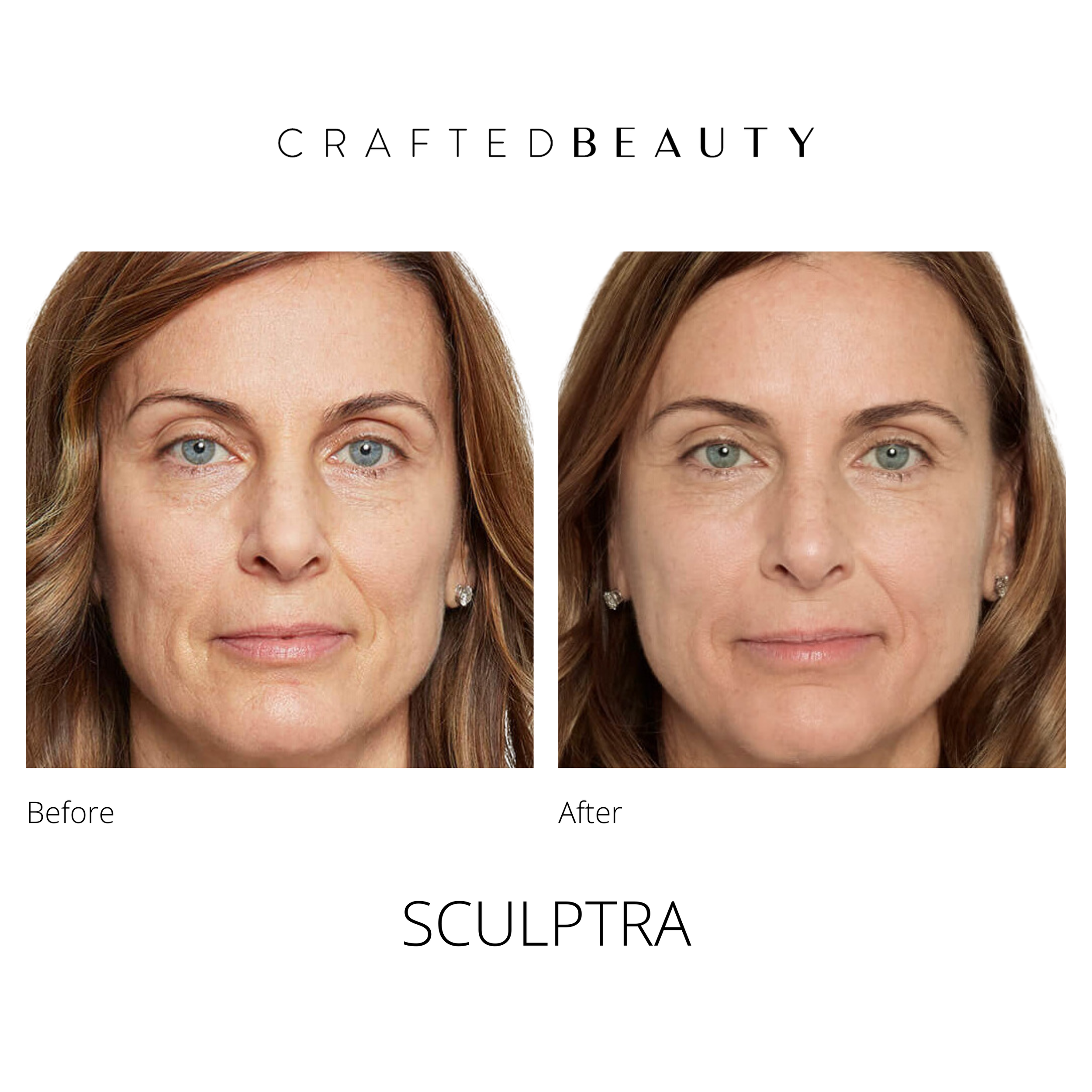 Sculptra results before and after