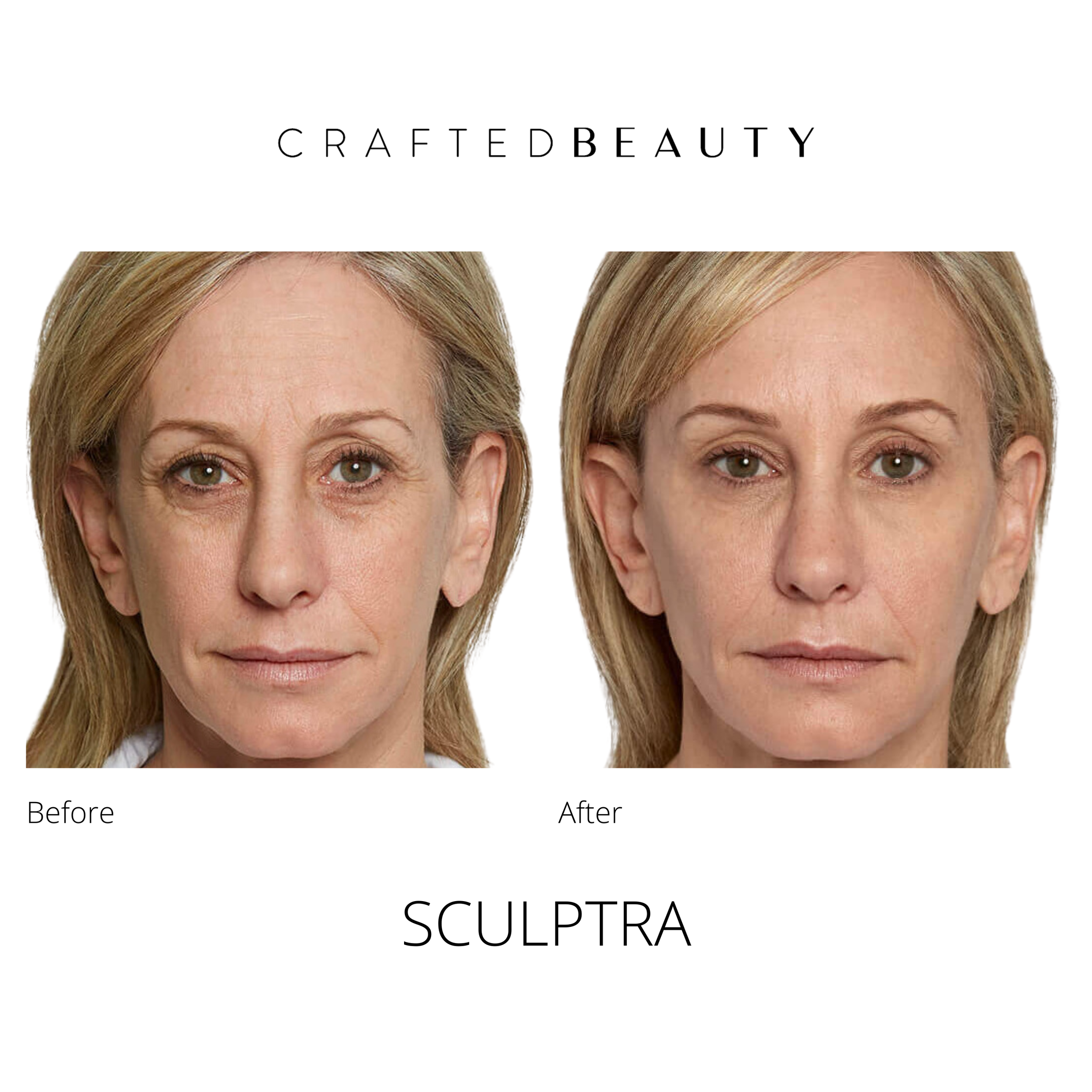 Sculptra results before and after