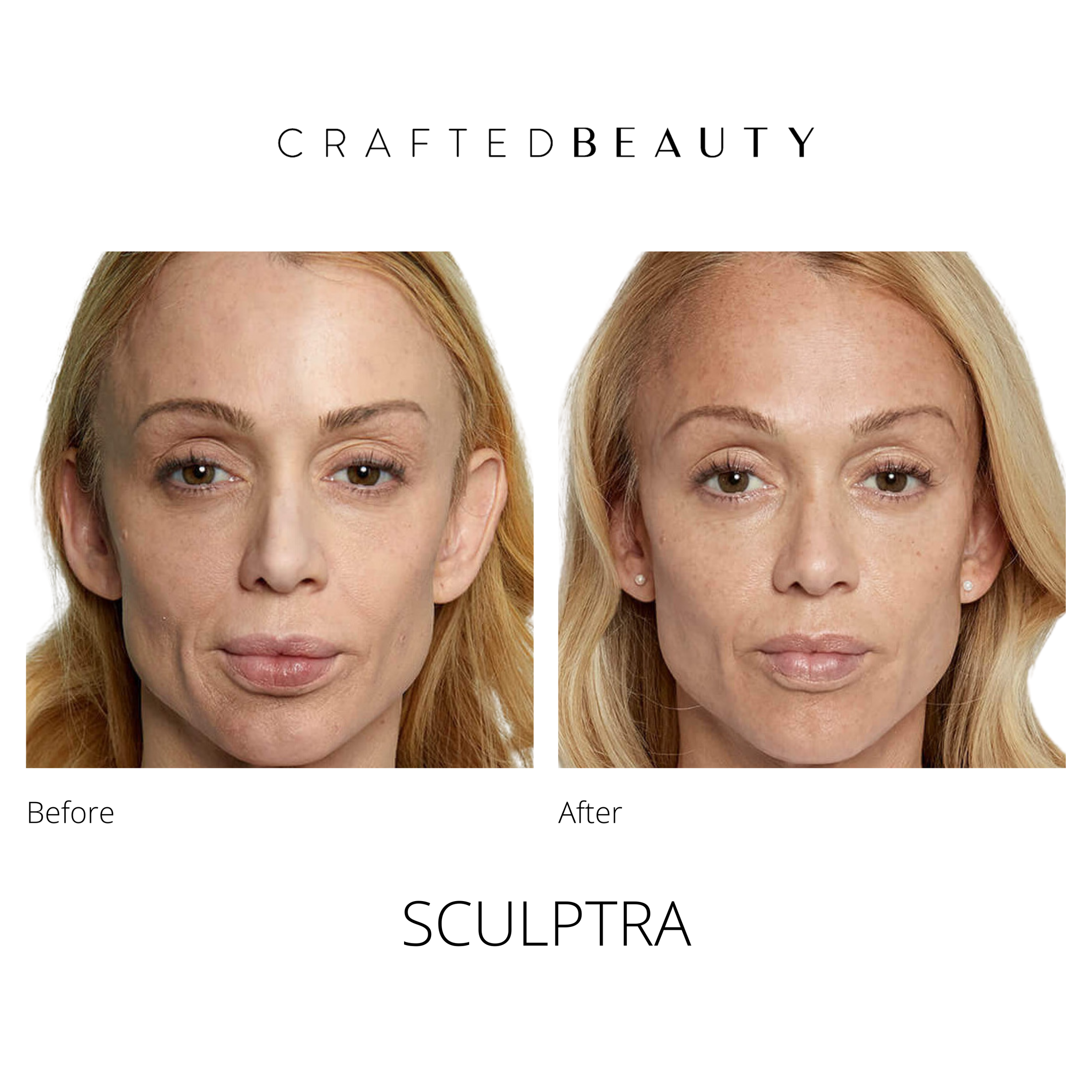 Sculptra