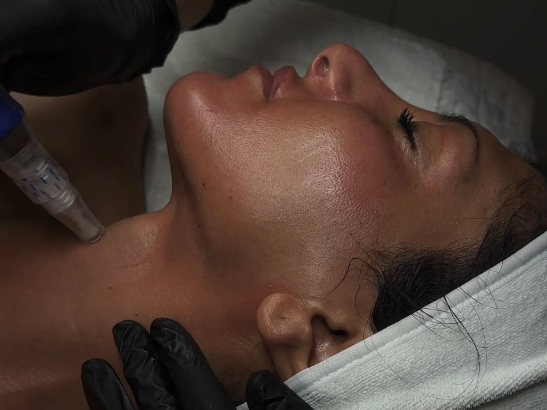 microneedling in spokane