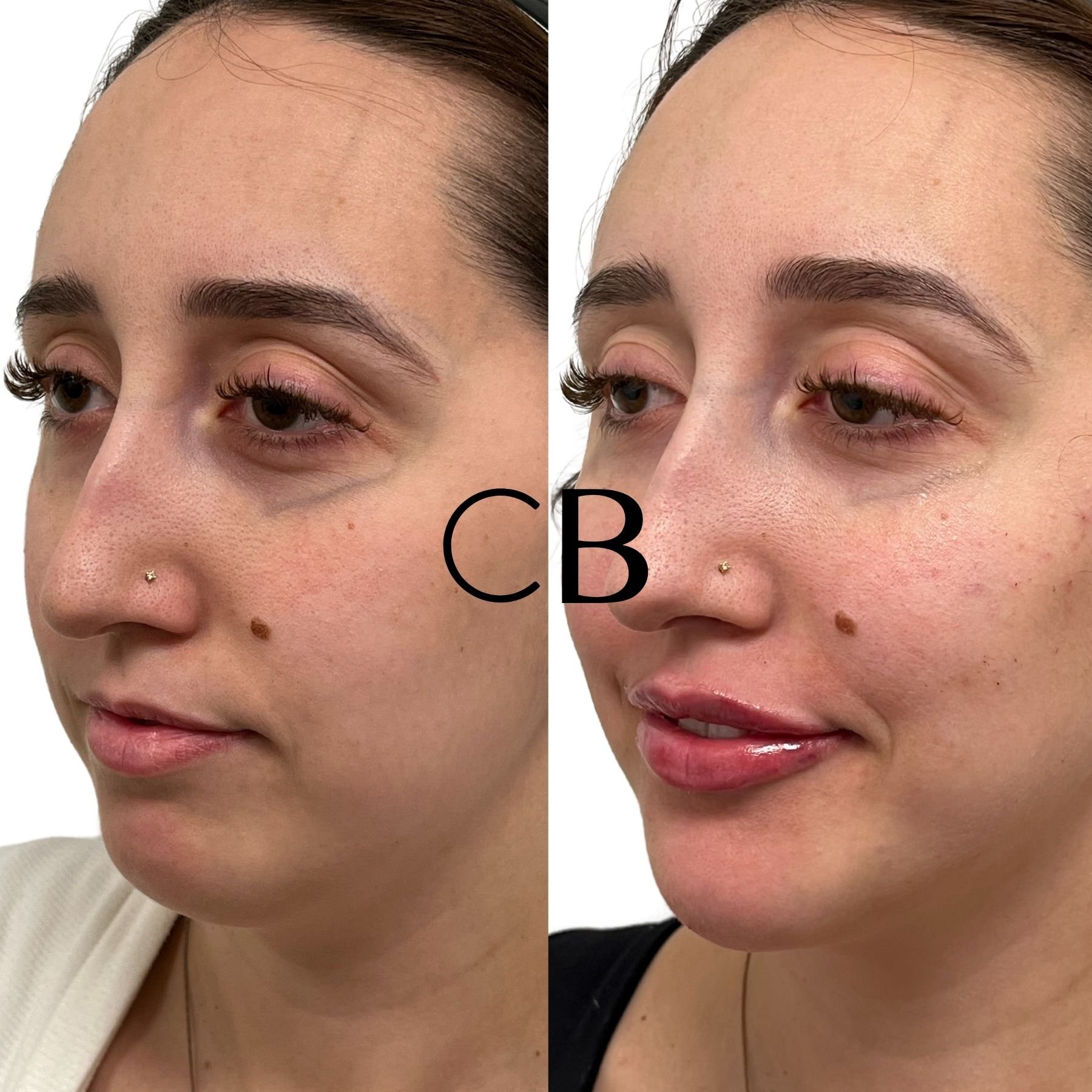 Dermal Filler Before and After