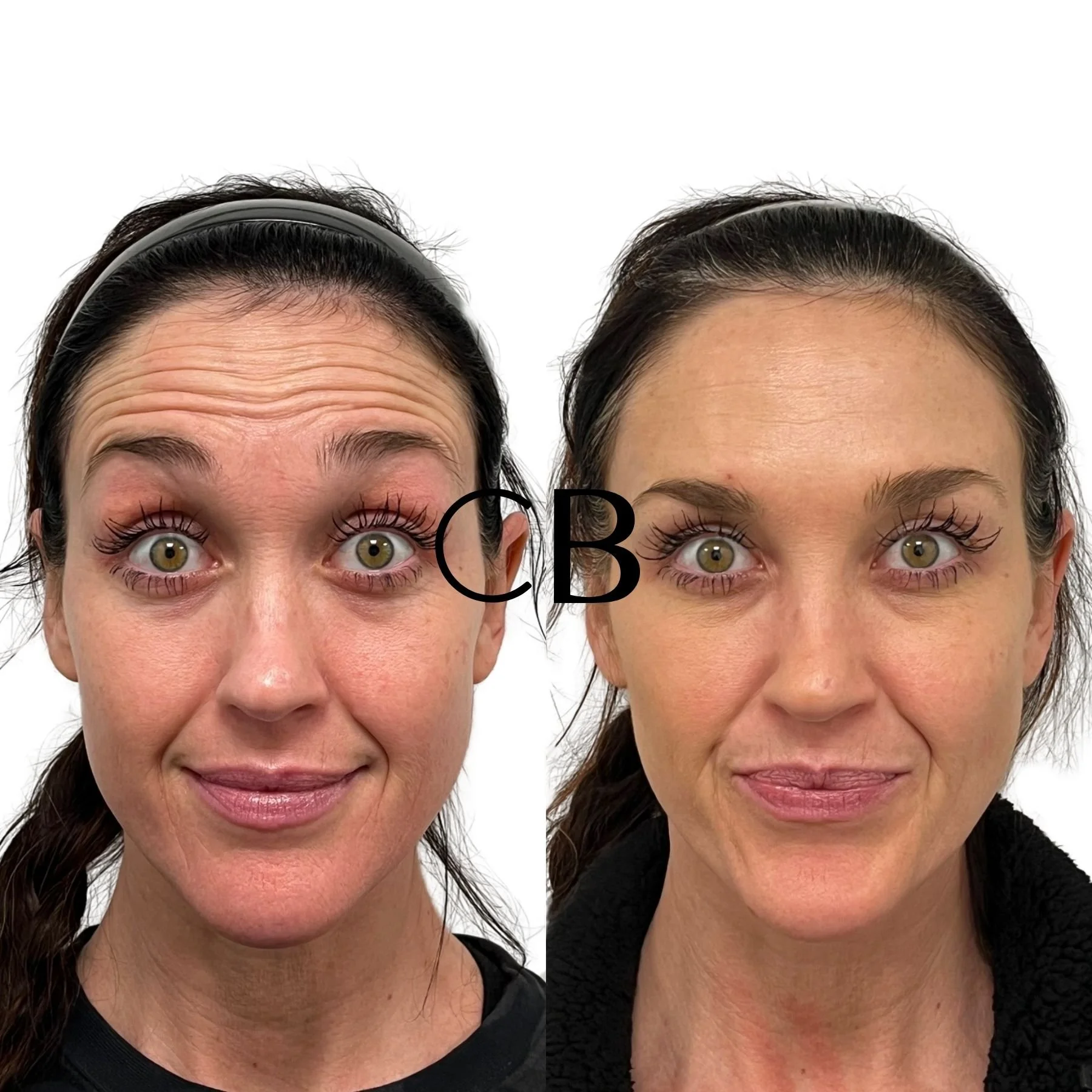 Botox before and after Spokane WA