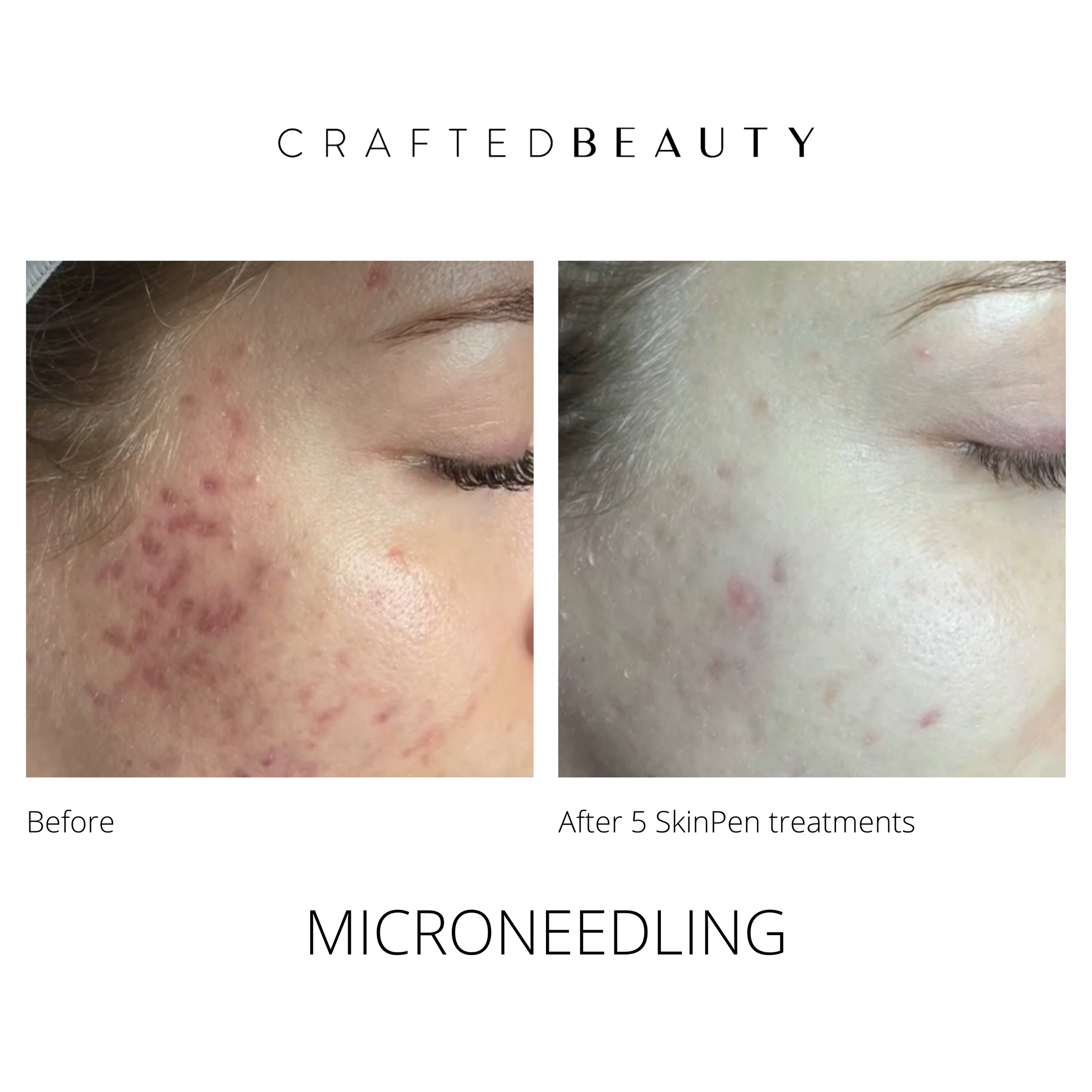SkinPen microneedling results at Crafted Beauty Medical Spa