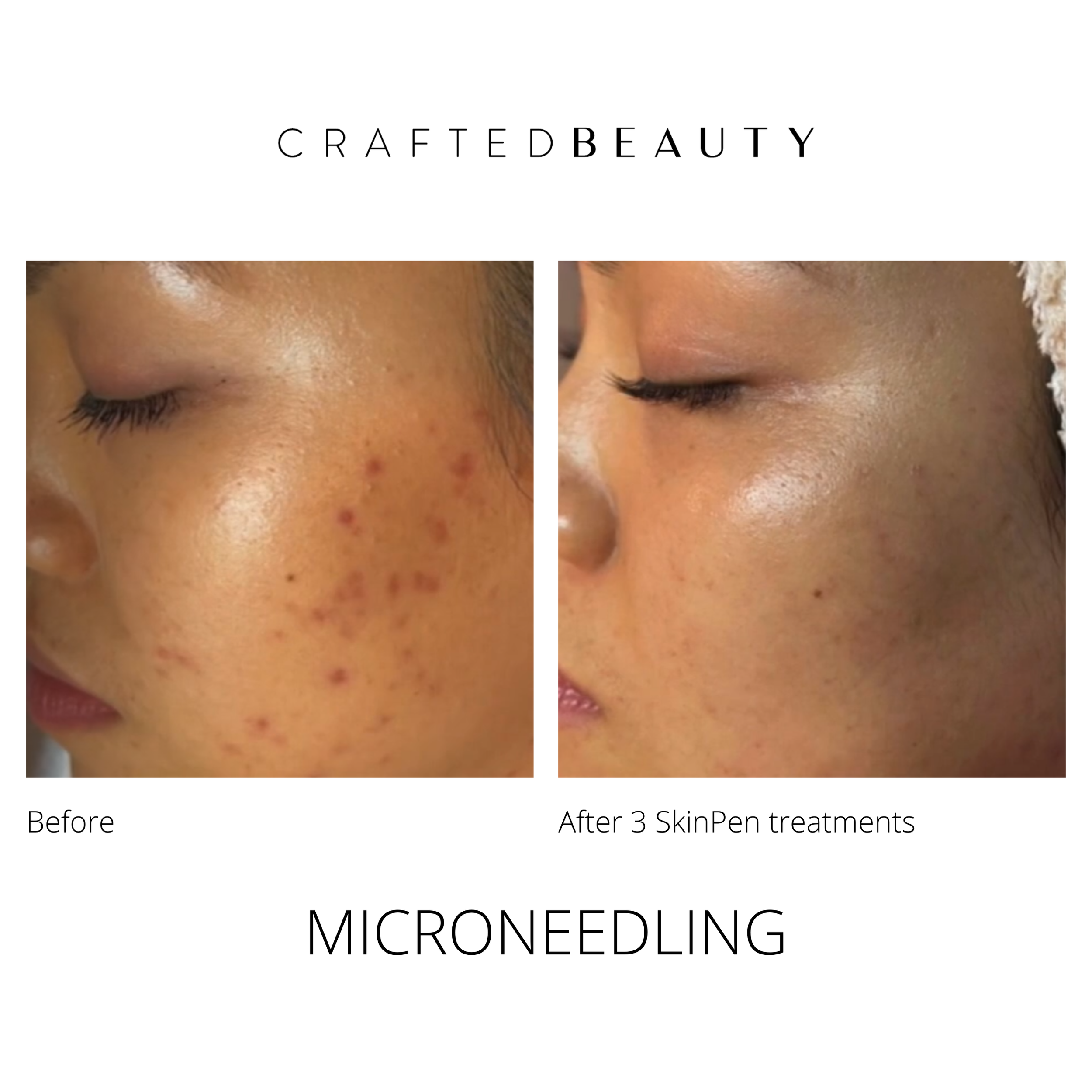 SkinPen microneedling results at Crafted Beauty Medical Spa. 