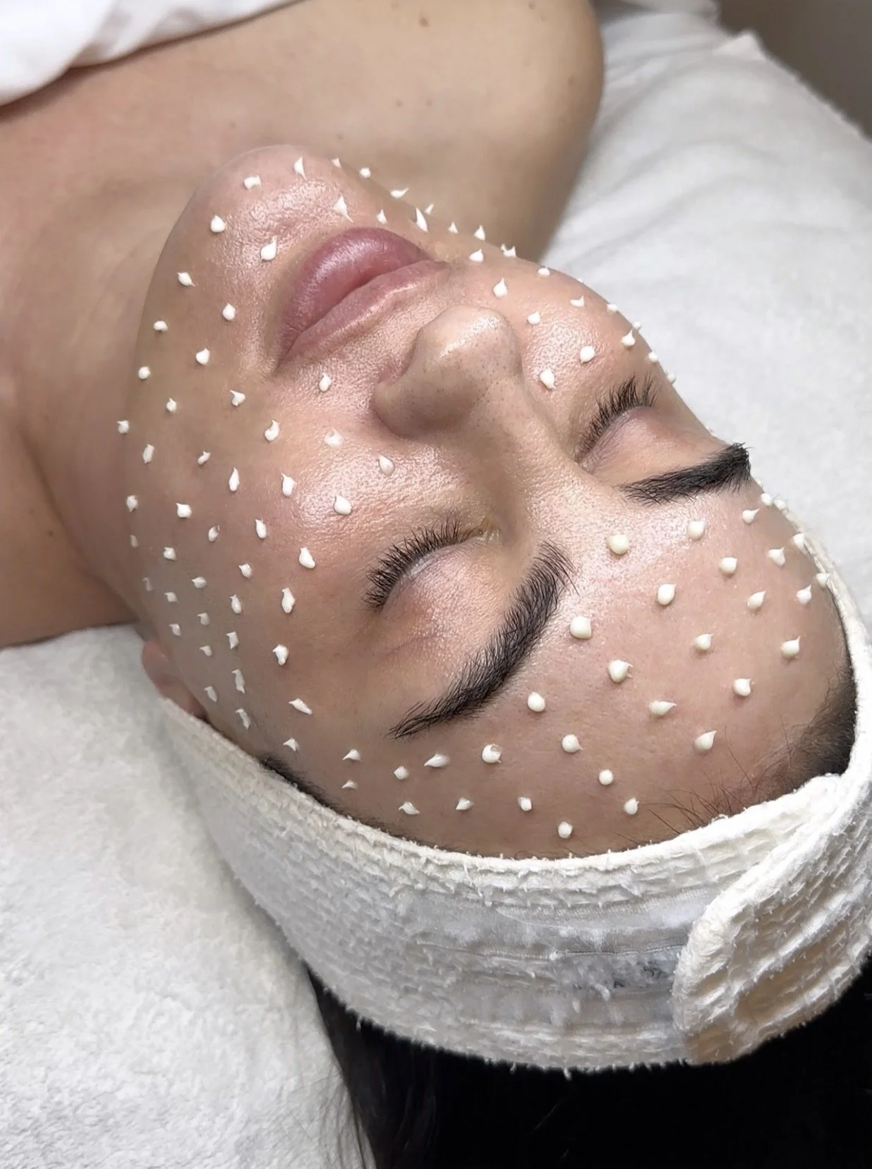 A woman lying down with her eyes closed, undergoing a facial treatment with small white dots on her face, wearing a white headband.