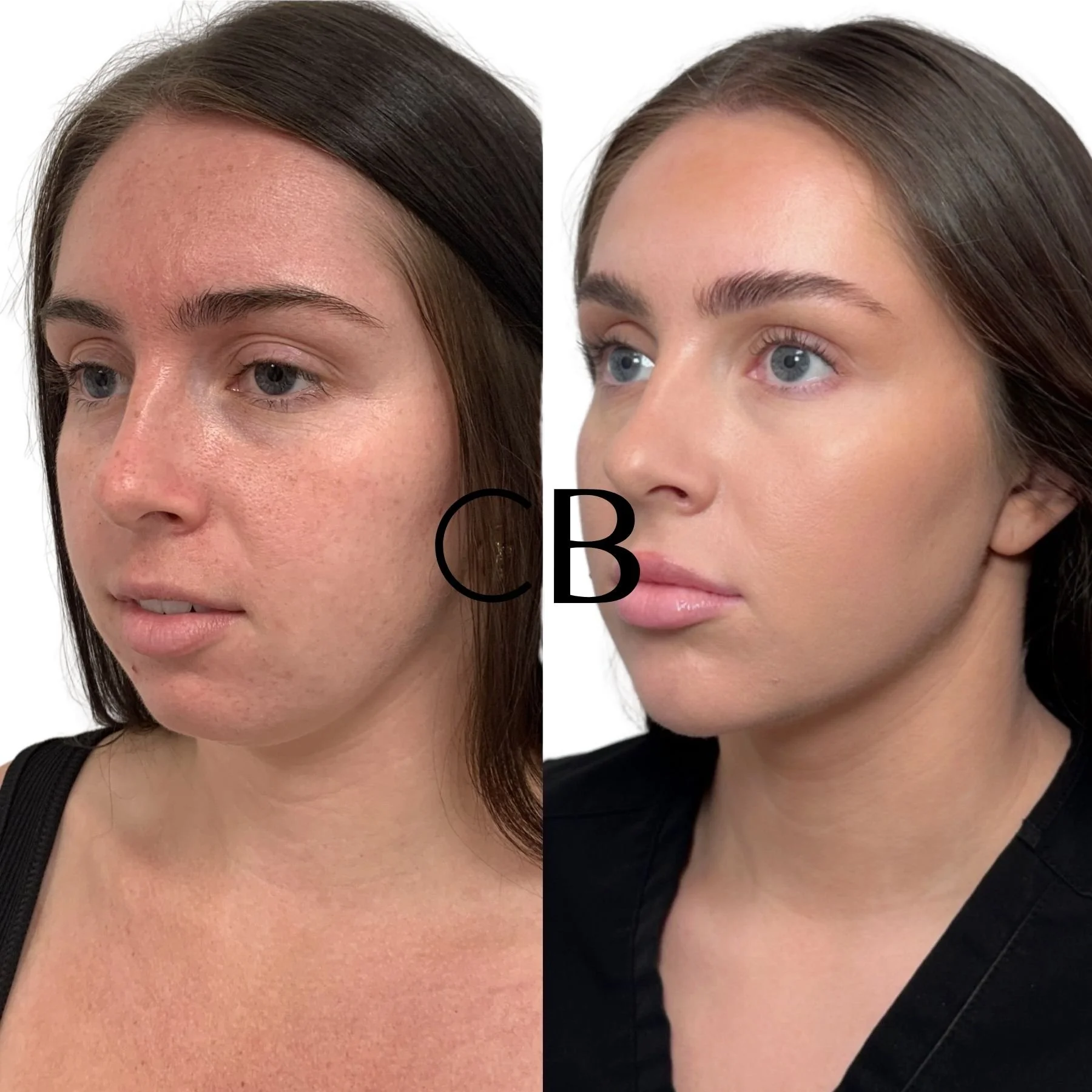Dermal Filler Before and After