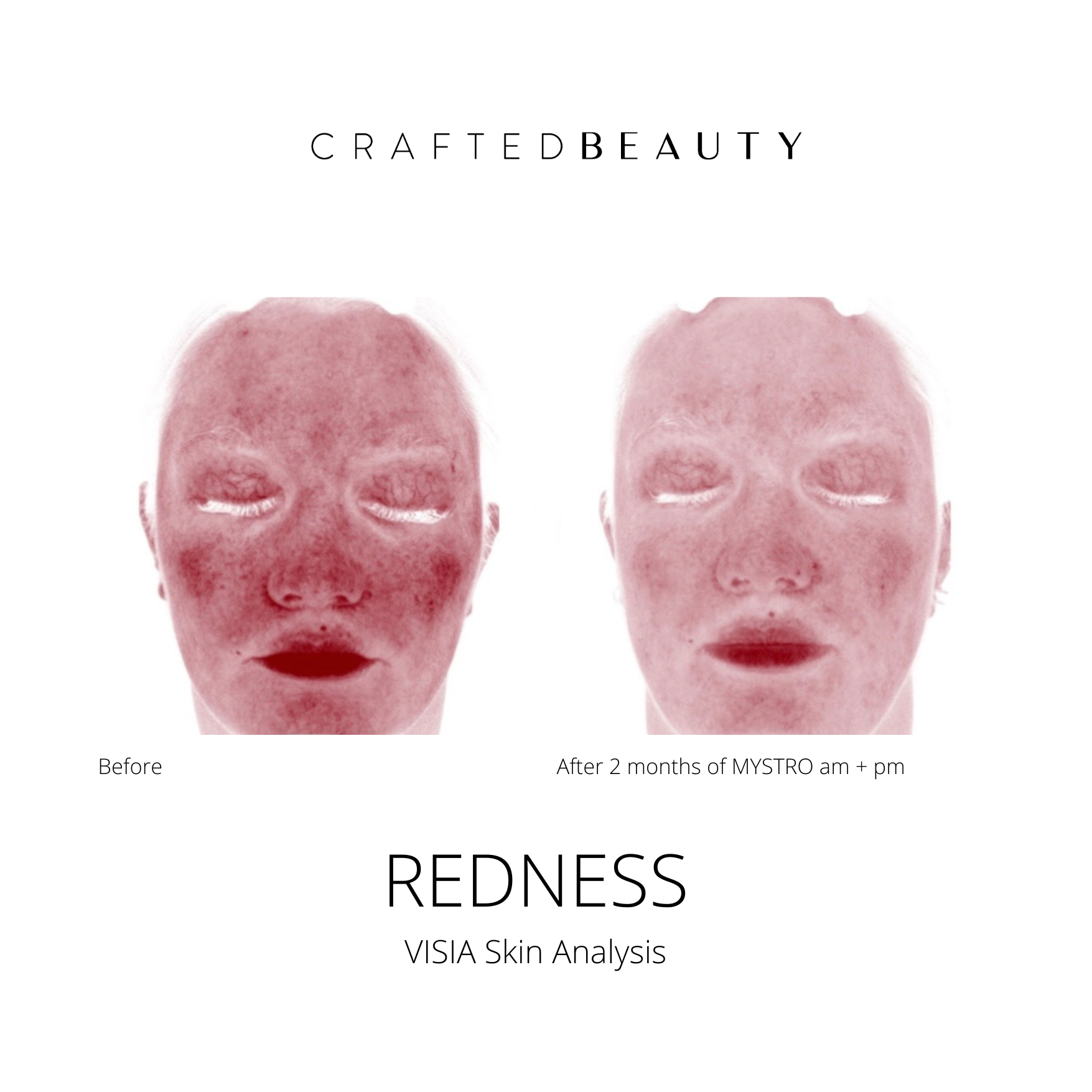 Redness improvement from VISIA Skin Analysis