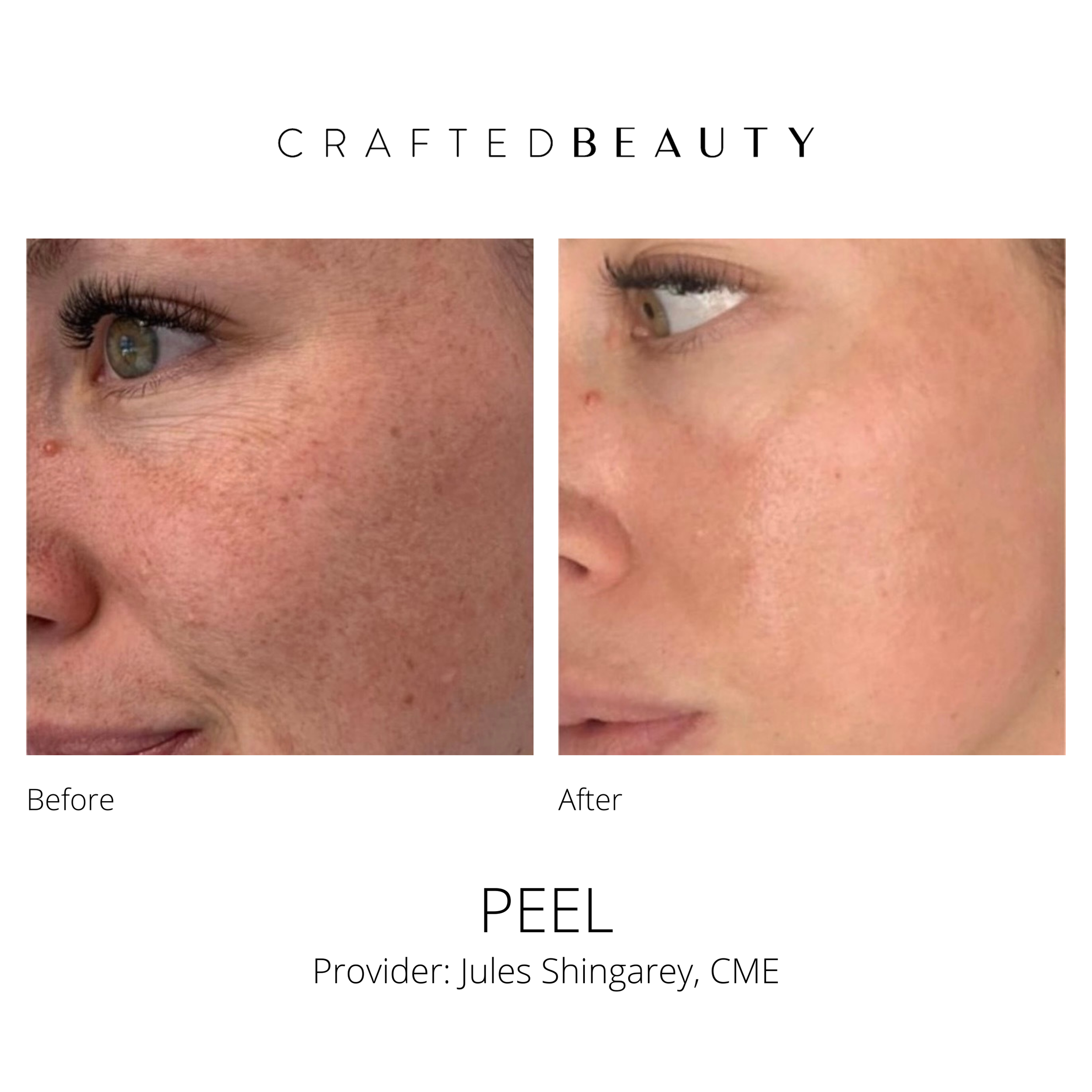 Peel skin results at Crafted Beauty Medical Spa