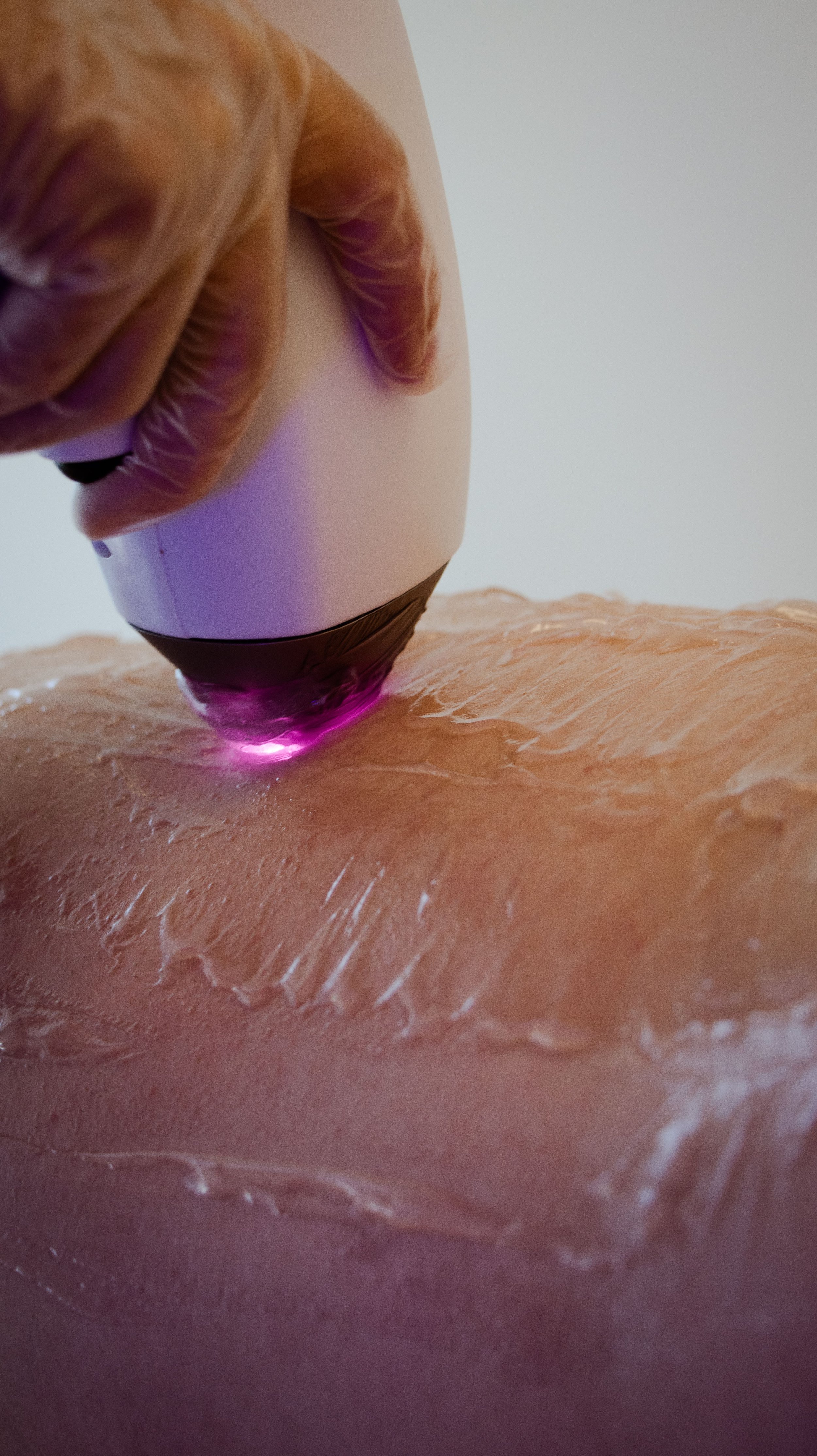 Near-infrared hair removal device with a white body and black base, emitting purple light onto a person's arm for hair removal treatment.