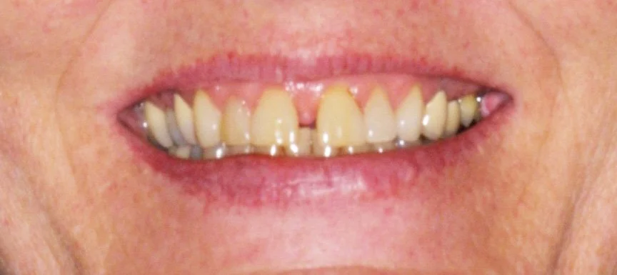 Upper Porcelain Veneers & Crowns