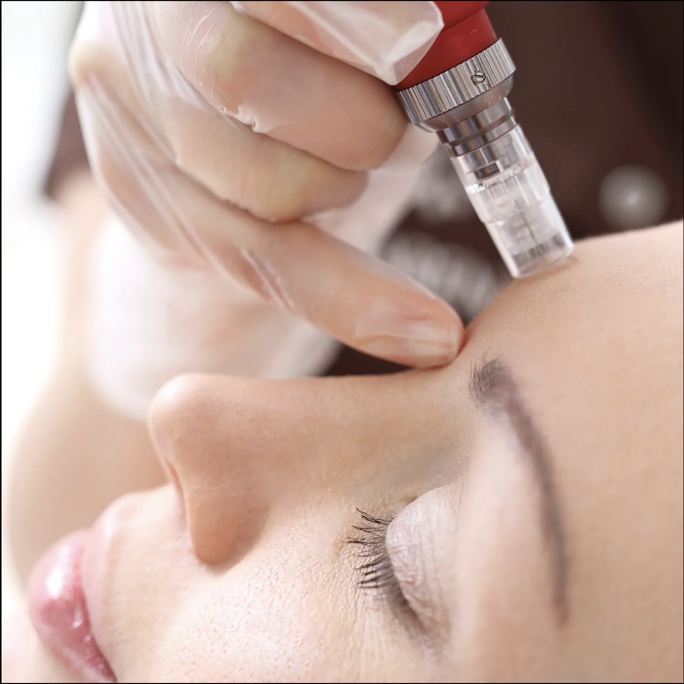 Microneedling: Stimulating Natural Skin Renewal