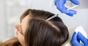 PRP for Hair Loss: Stimulating Natural Hair Growth