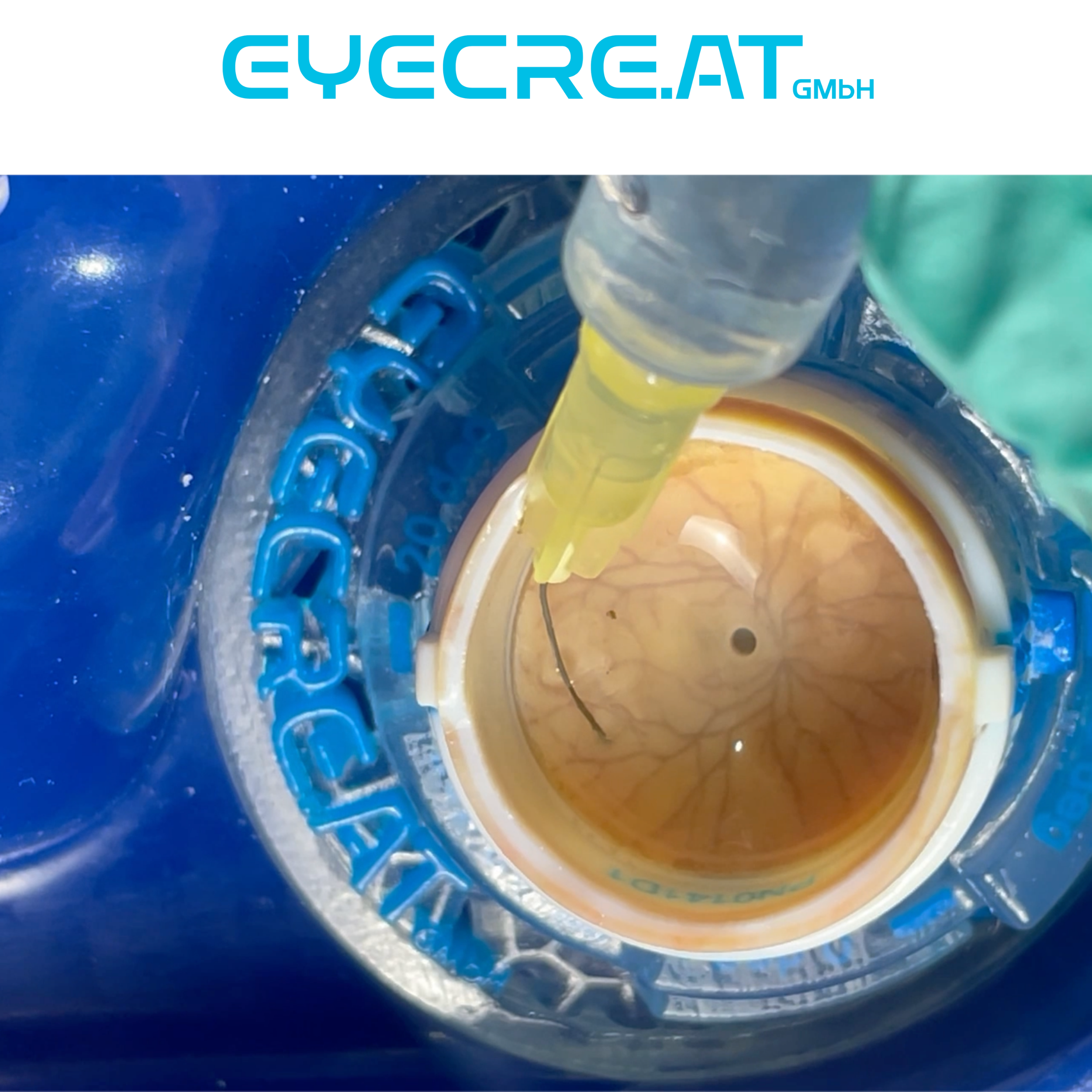 vitrectomy.png