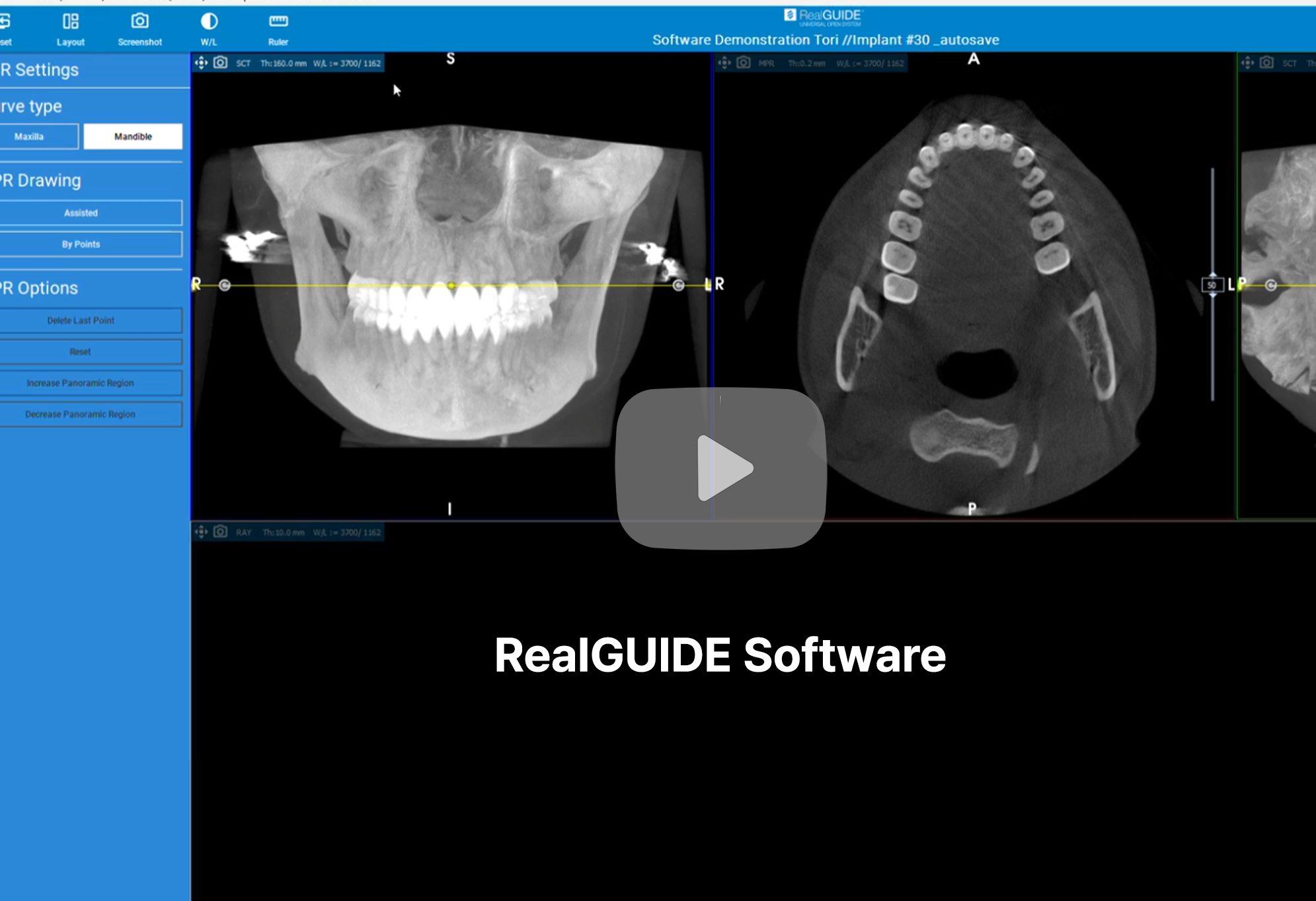 Screenshot of dental imaging software displaying X-ray images of a patient's skull and teeth, with the software name RealGUIDE Software visible.