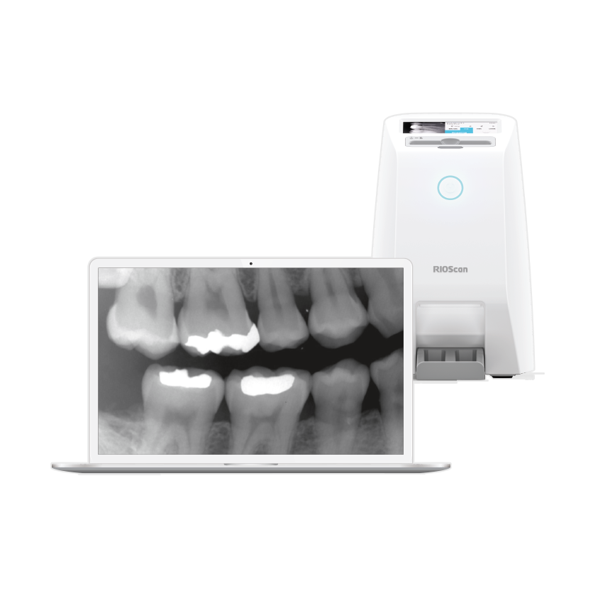 Dental X-ray displayed on a laptop screen next to a digital dental scanner.