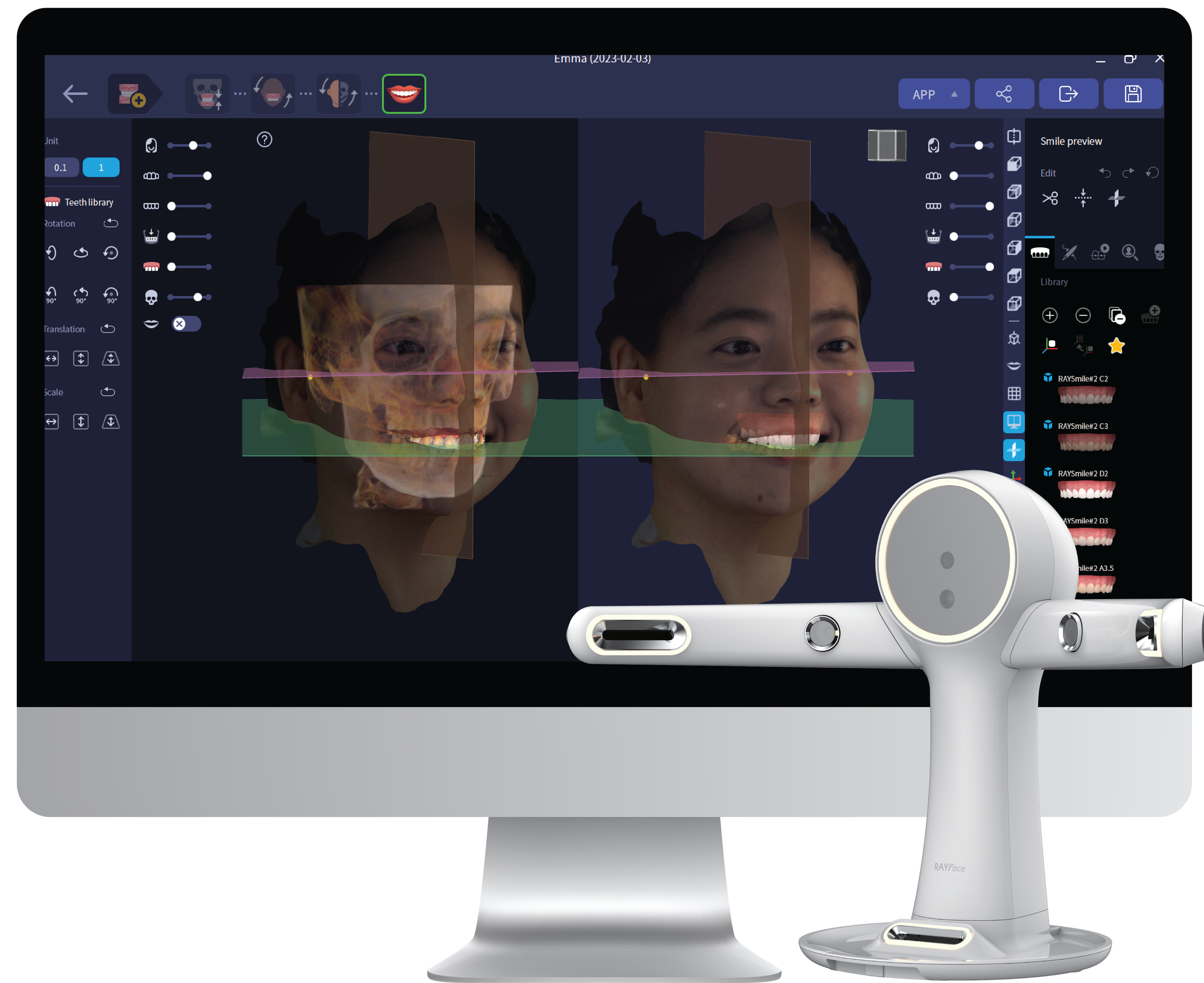 Transforming Smiles with RAY Digital Smile Design