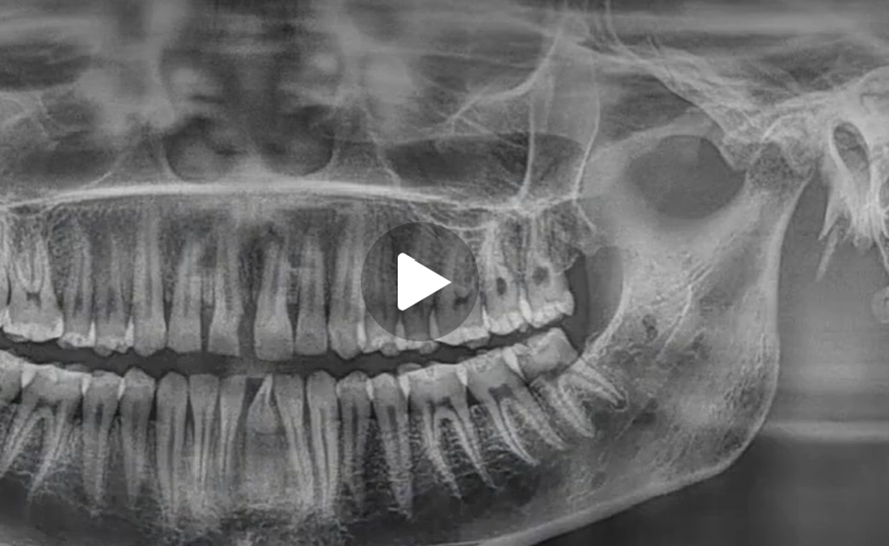 Screenshot of dental imaging software displaying X-ray images of a patient's skull and teeth, with the software name RealGUIDE Software visible.