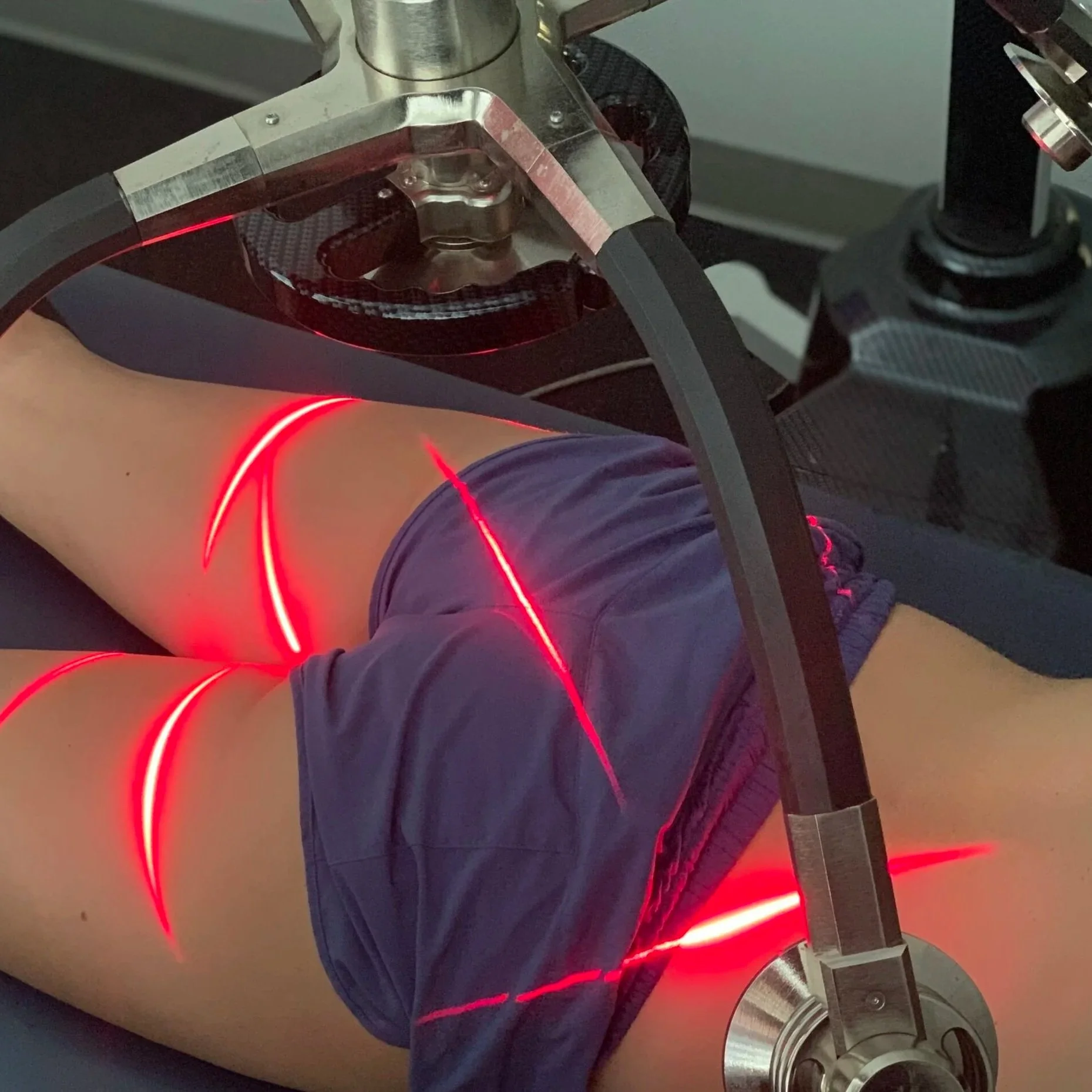 Erchonia Zerona Laser on a patient at ICE