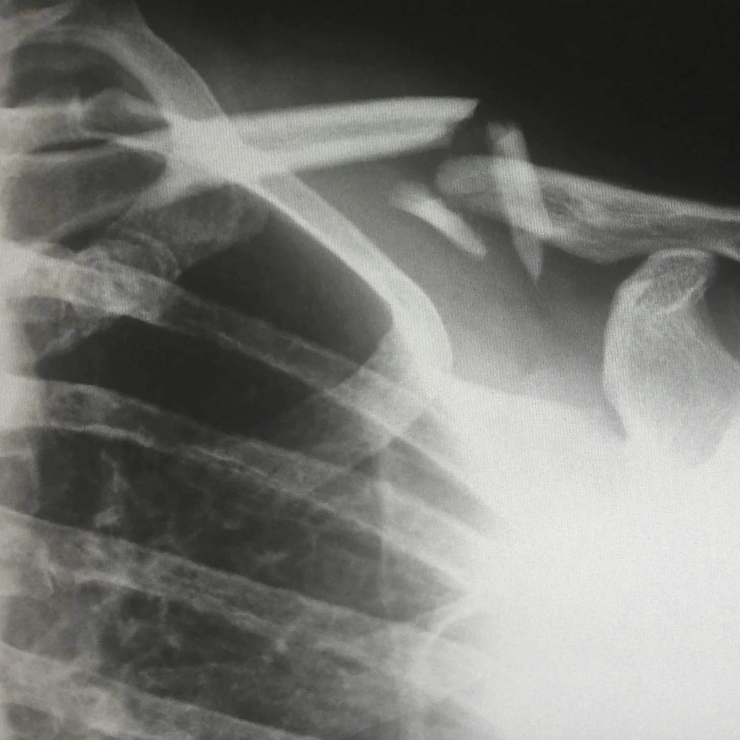 X-ray showing a broken collarbone from a work injury