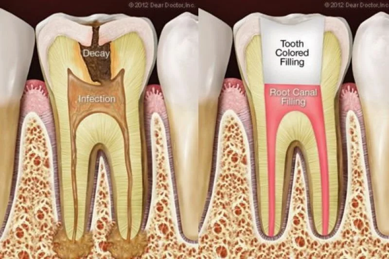 Are Root Canals Safe?