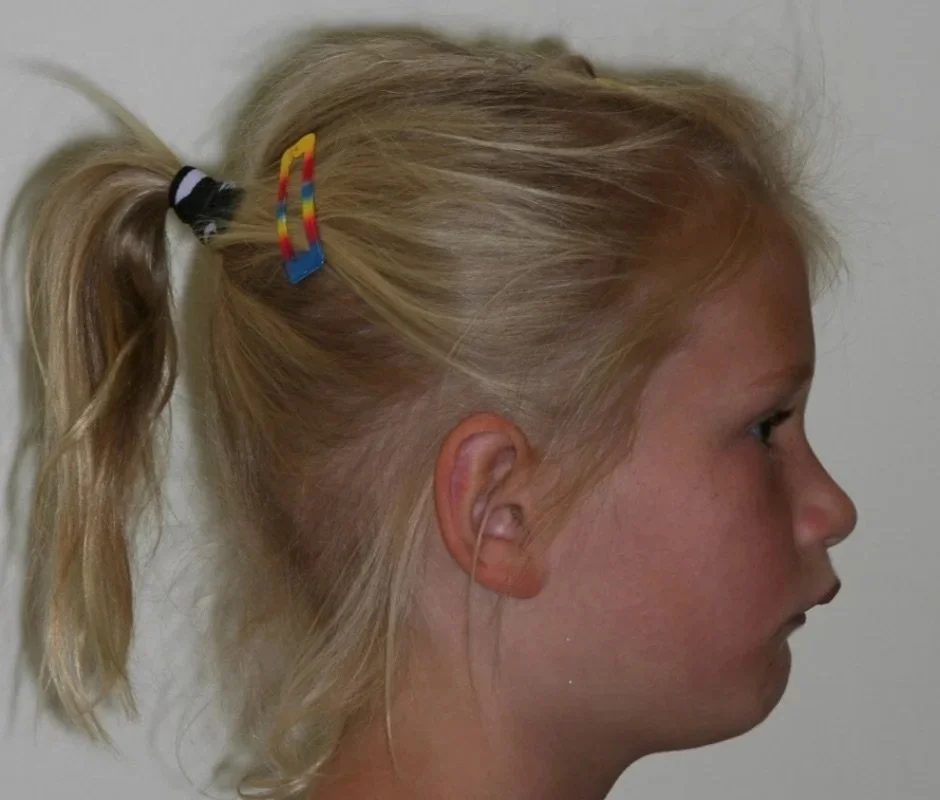 Child before orthotropic treatment at Quin Dental Nelson