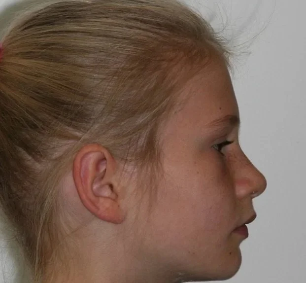 Child after orthotropic treatment at Quin Dental Nelson