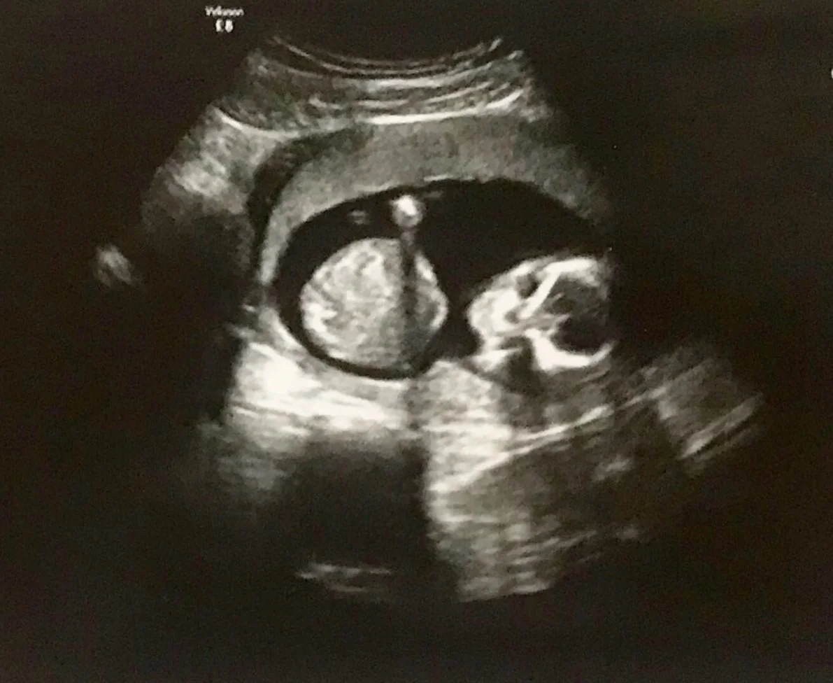Ultrasound image of a fetus inside the womb.