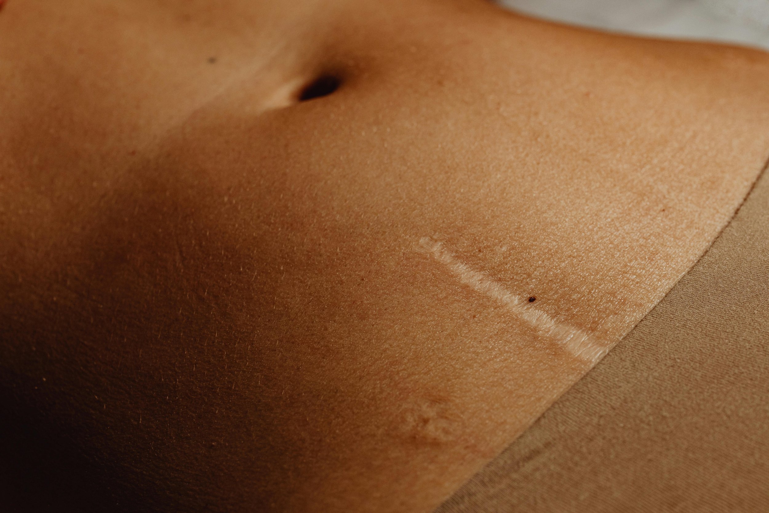 Close-up of a postpartum after birth, showing their navel, a small mole above it, and a faint scar or stretch mark on the lower abdomen.