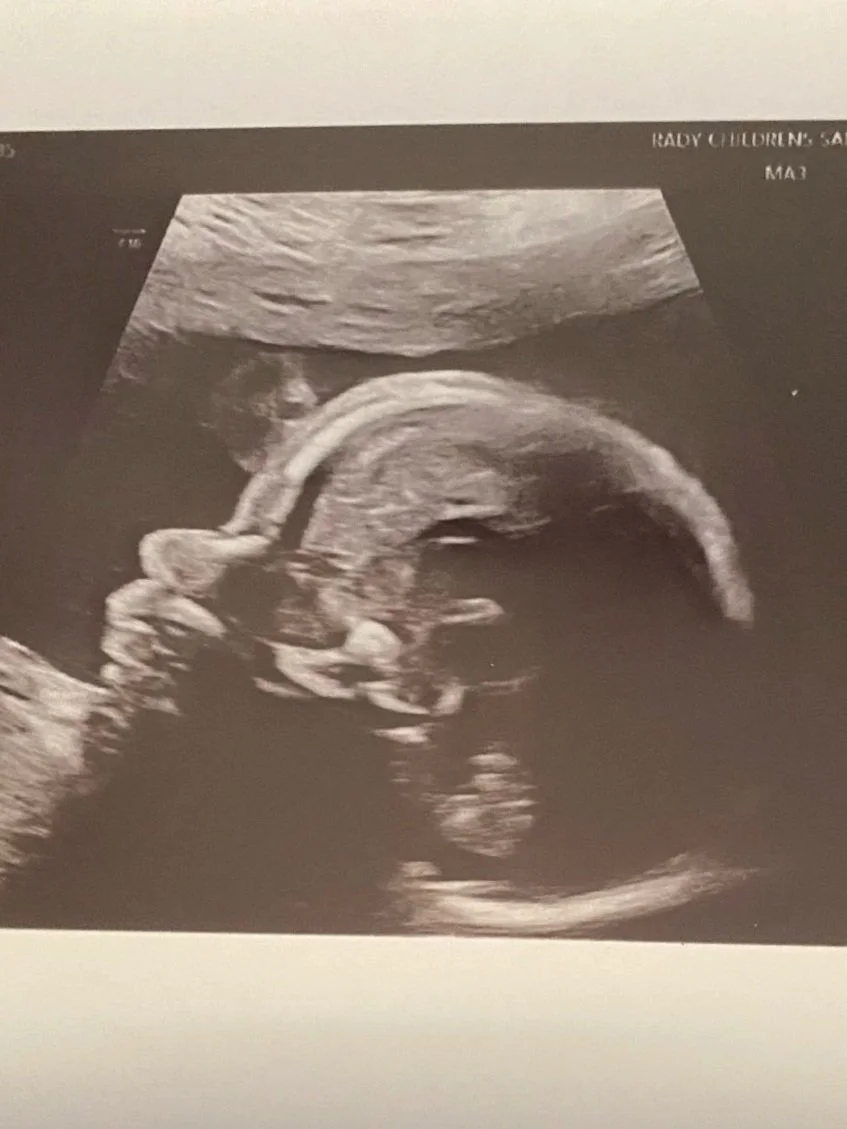 Ultrasound image of a pregnant woman's fetus in profile view.