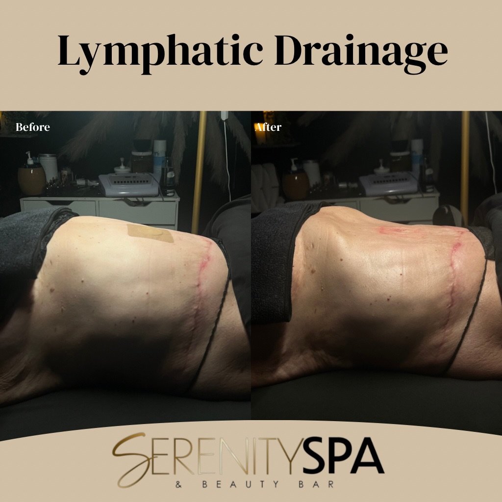 Post surgical massages are beneficial are beneficial for pain relief and debloating.

Included in all lymphatic massages is Red Light Therapy which is best for chronic inflammation, skin elasticity, pain relief, and cell rebuilding.

Book your next l