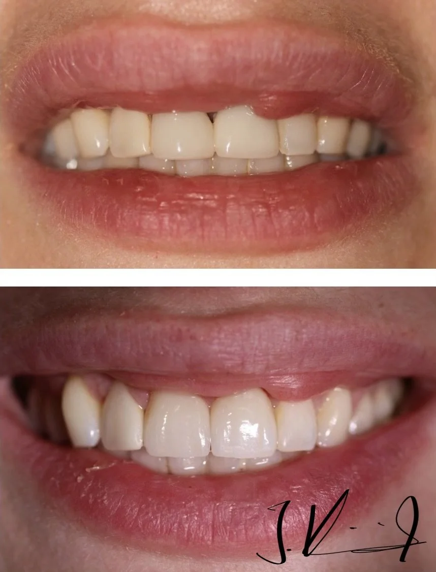 Close-up of a person's smile showing teeth before and after dental work (Veneers)