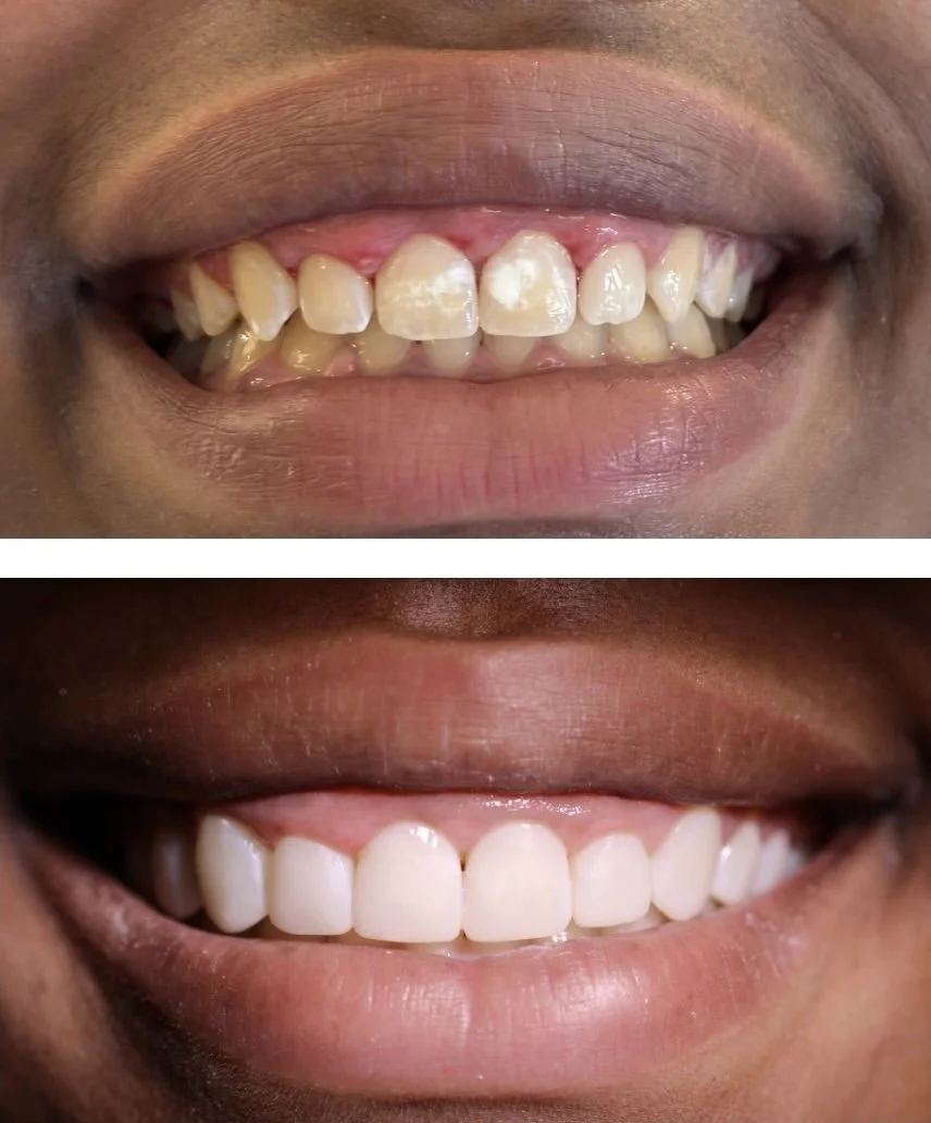 Comparison of a person's teeth before and after dental treatment (Composite Veneers), showing improved whiteness and alignment in the after image.