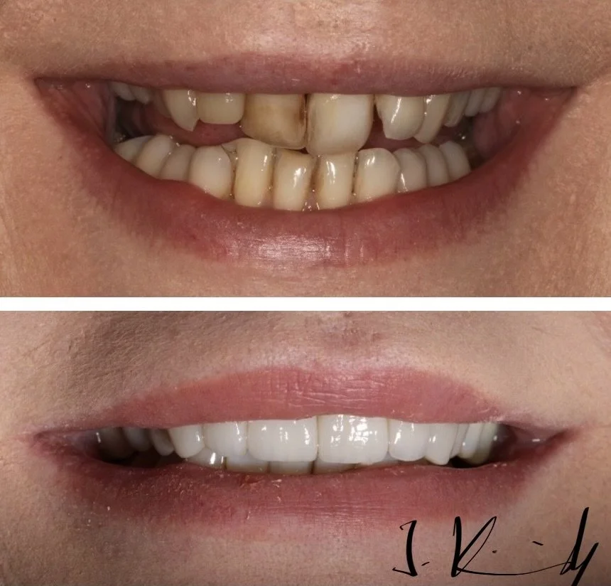 Comparison of teeth before and after dental treatment showing improved appearance.