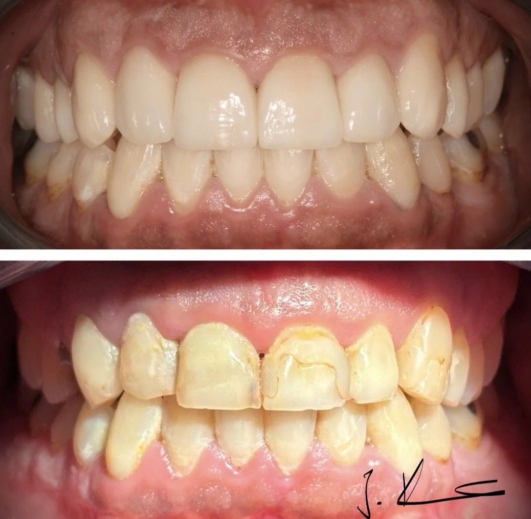 Comparison smile makeover with Crowns and Veneers