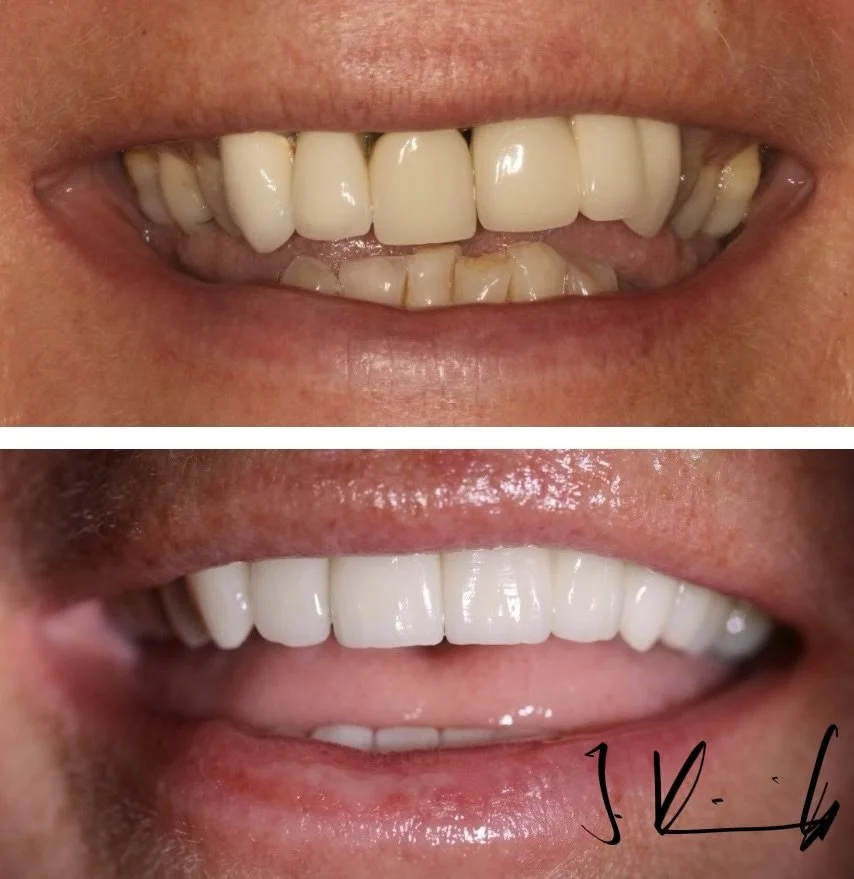 Comparison of teeth before and after dental work (Veneers, Crowns, Implants), showing improvement in alignment and appearance.