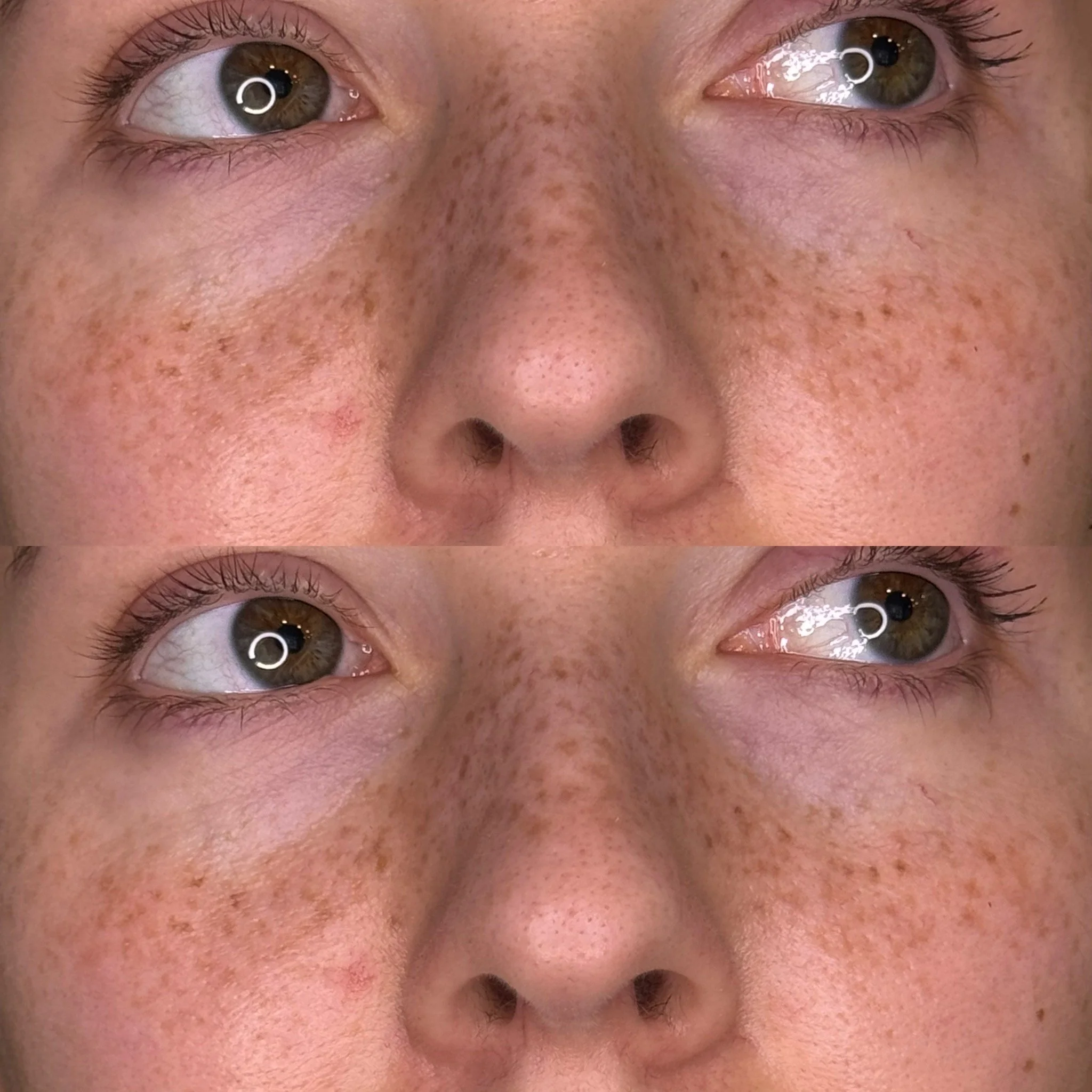 Close-up of a woman's face showing their healed faux freckle tattoos