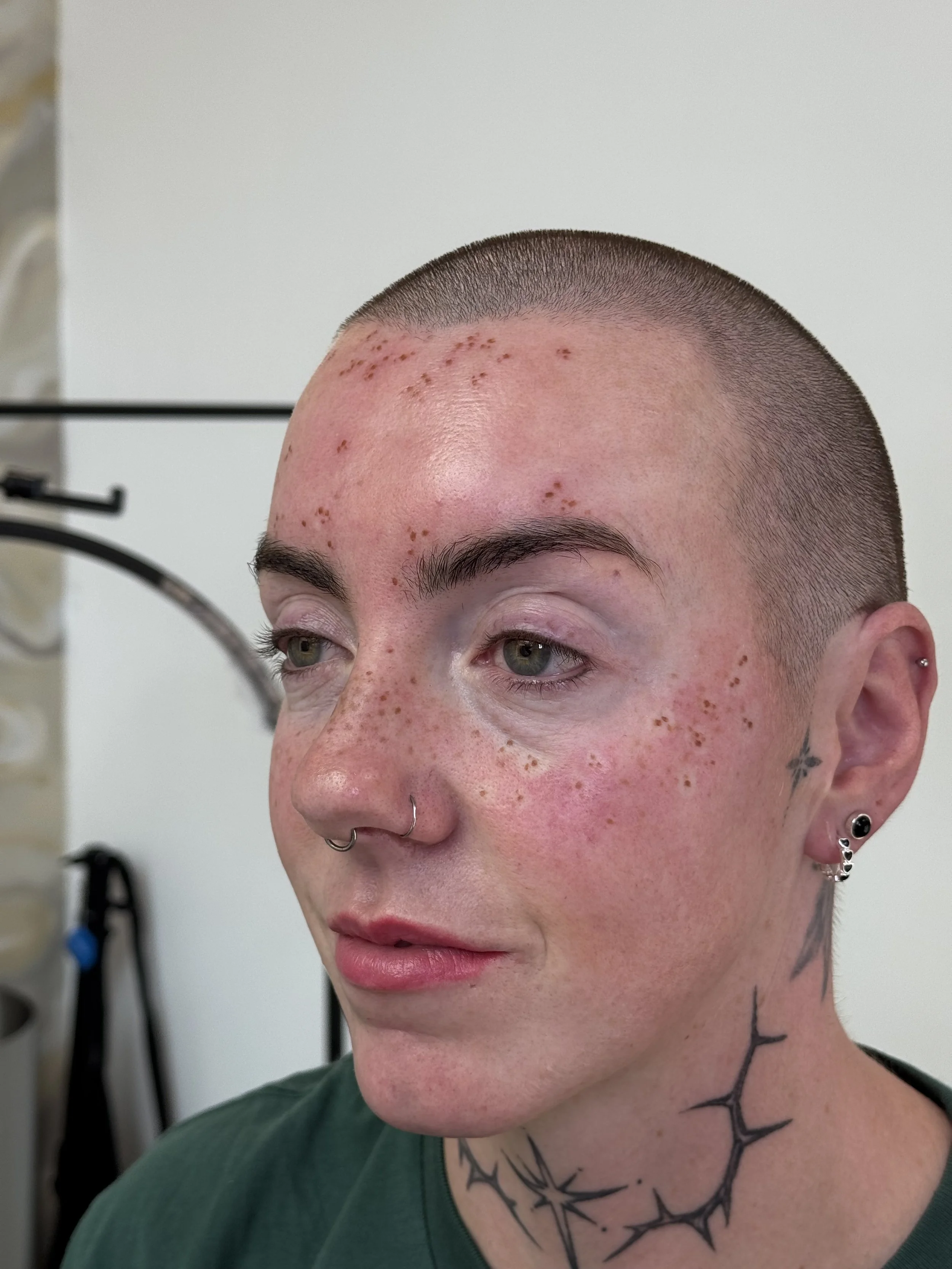 Close-up of a person's face showing a post-dermatology treatment with red spots and inflammation on the forehead and skin.