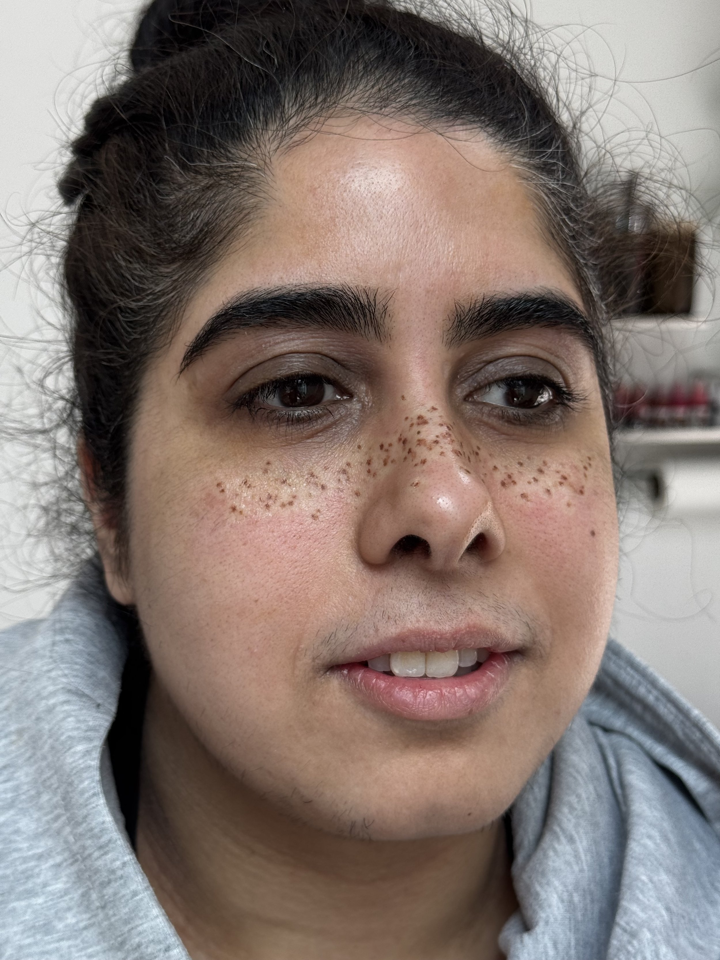 Close-up of a person's face showing dirt and freckles on the nose and cheeks, with dark hair and thick eyebrows, wearing a gray hoodie.